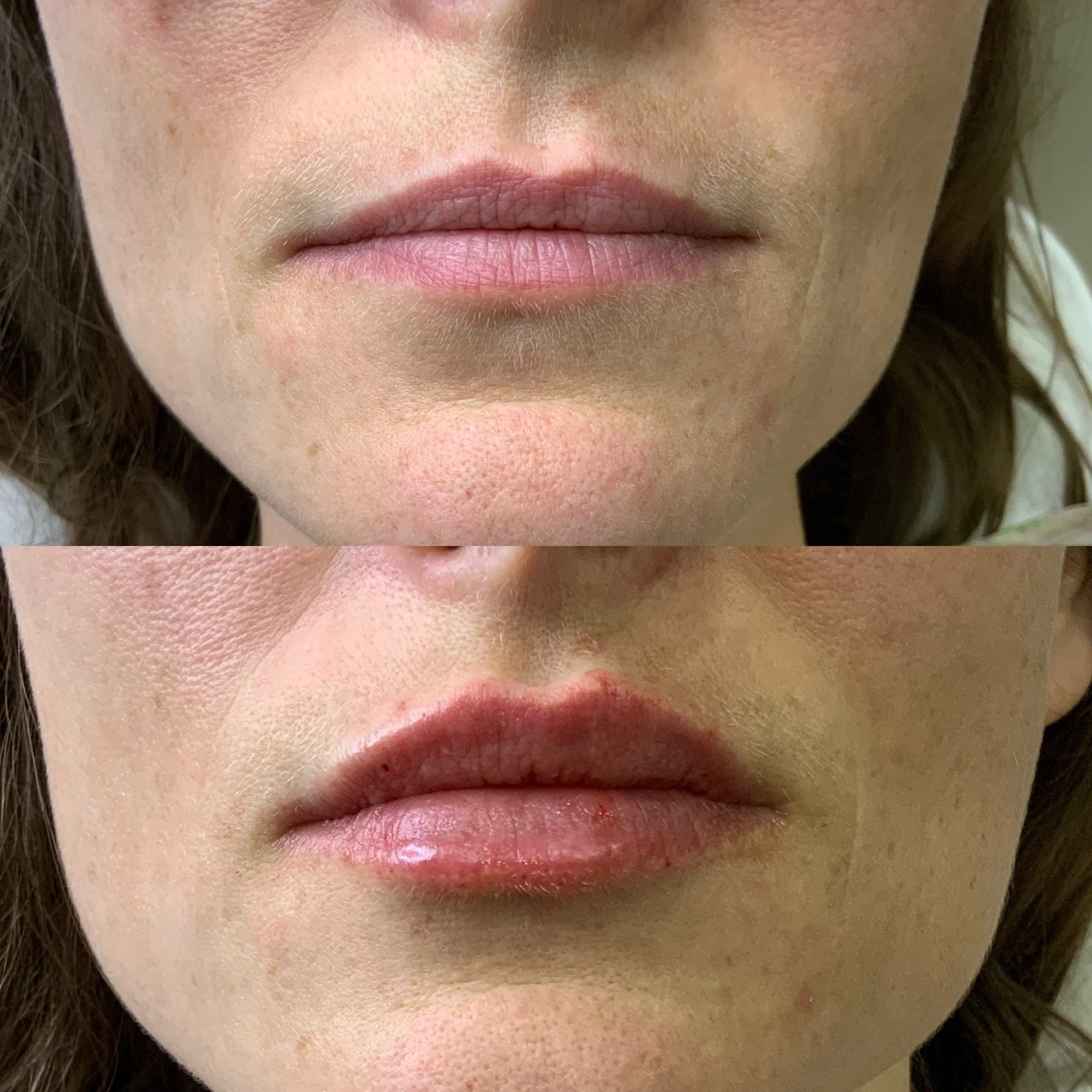 Lip FIller