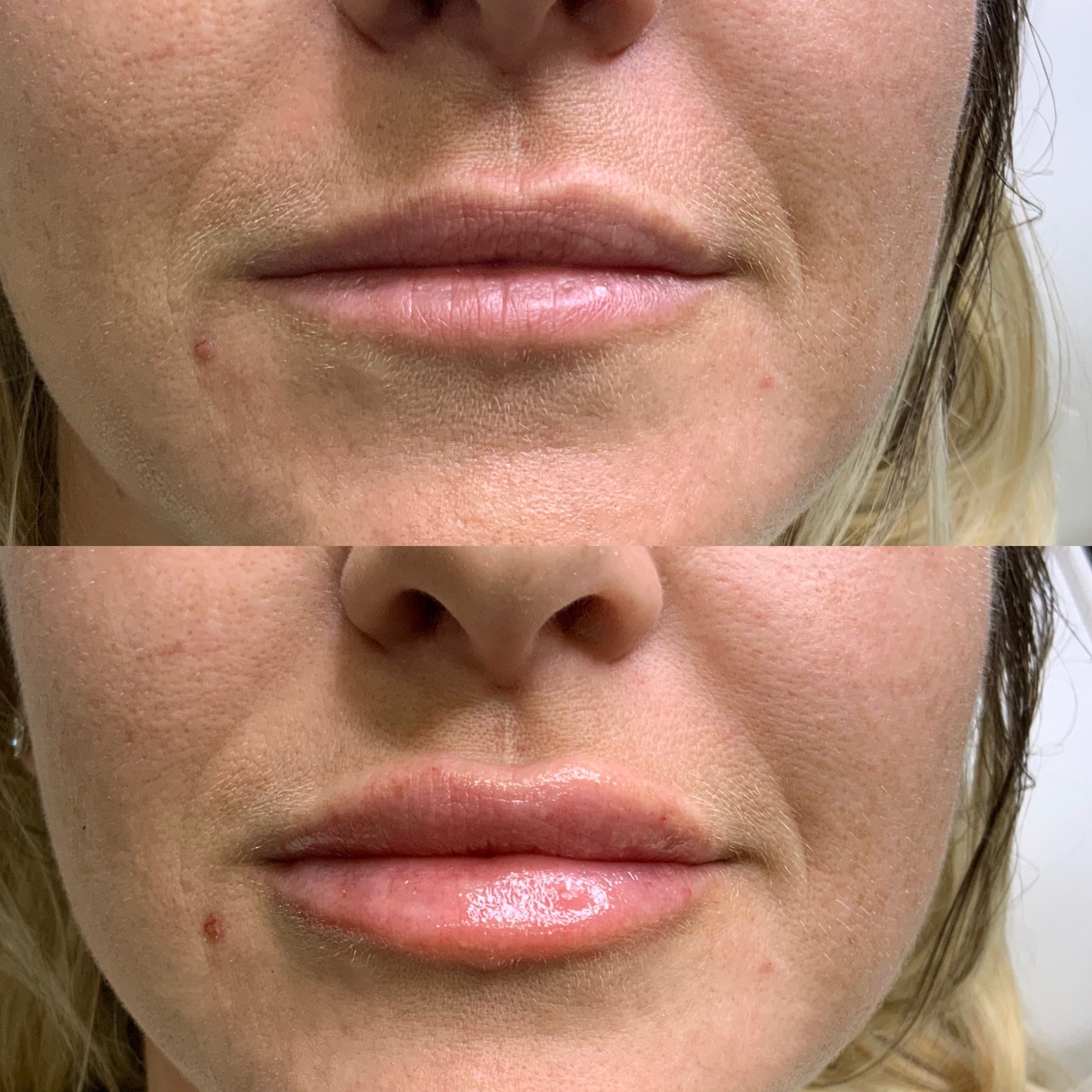 Lip Filler