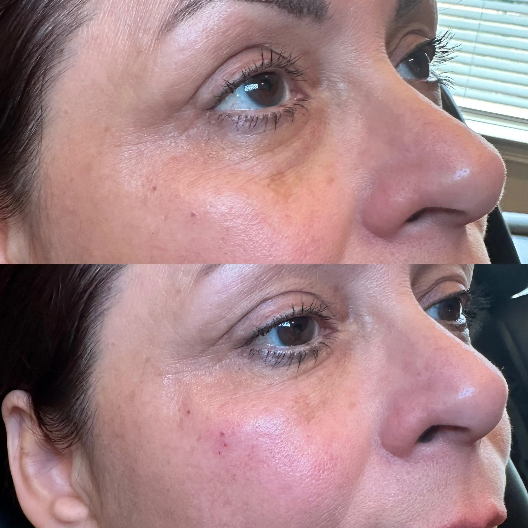 Under Eye Treatment