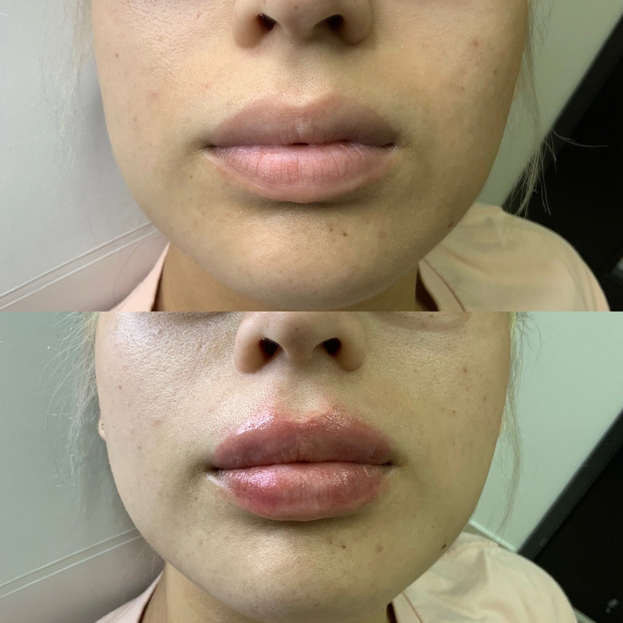 Lip FIller