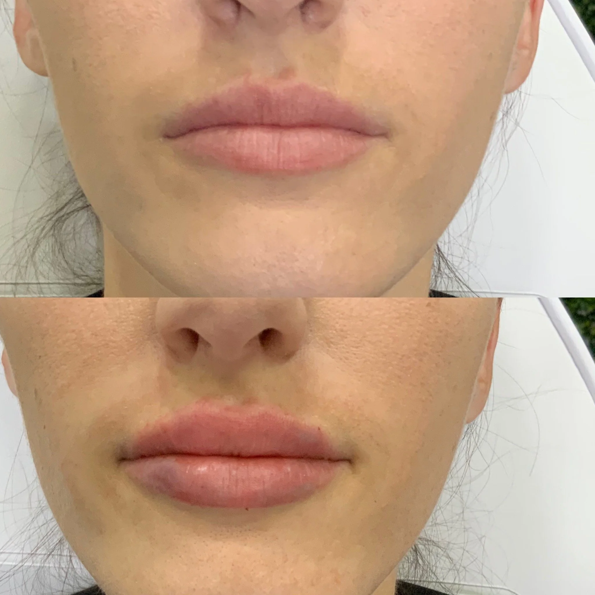 Lip FIller