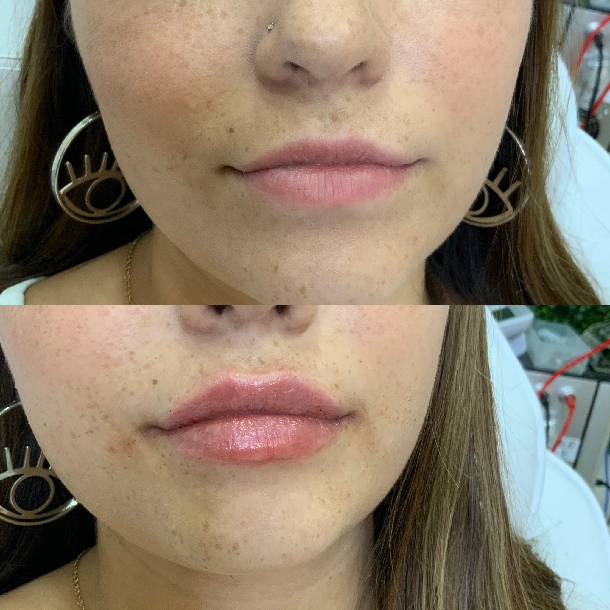 Lip FIller