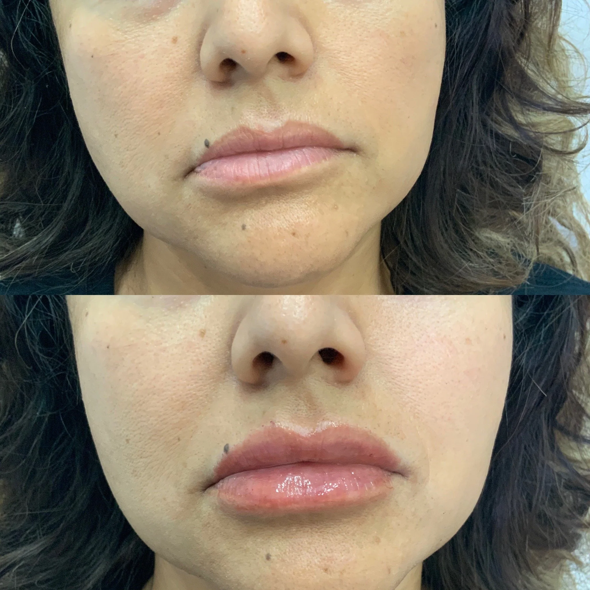 Lip Filler