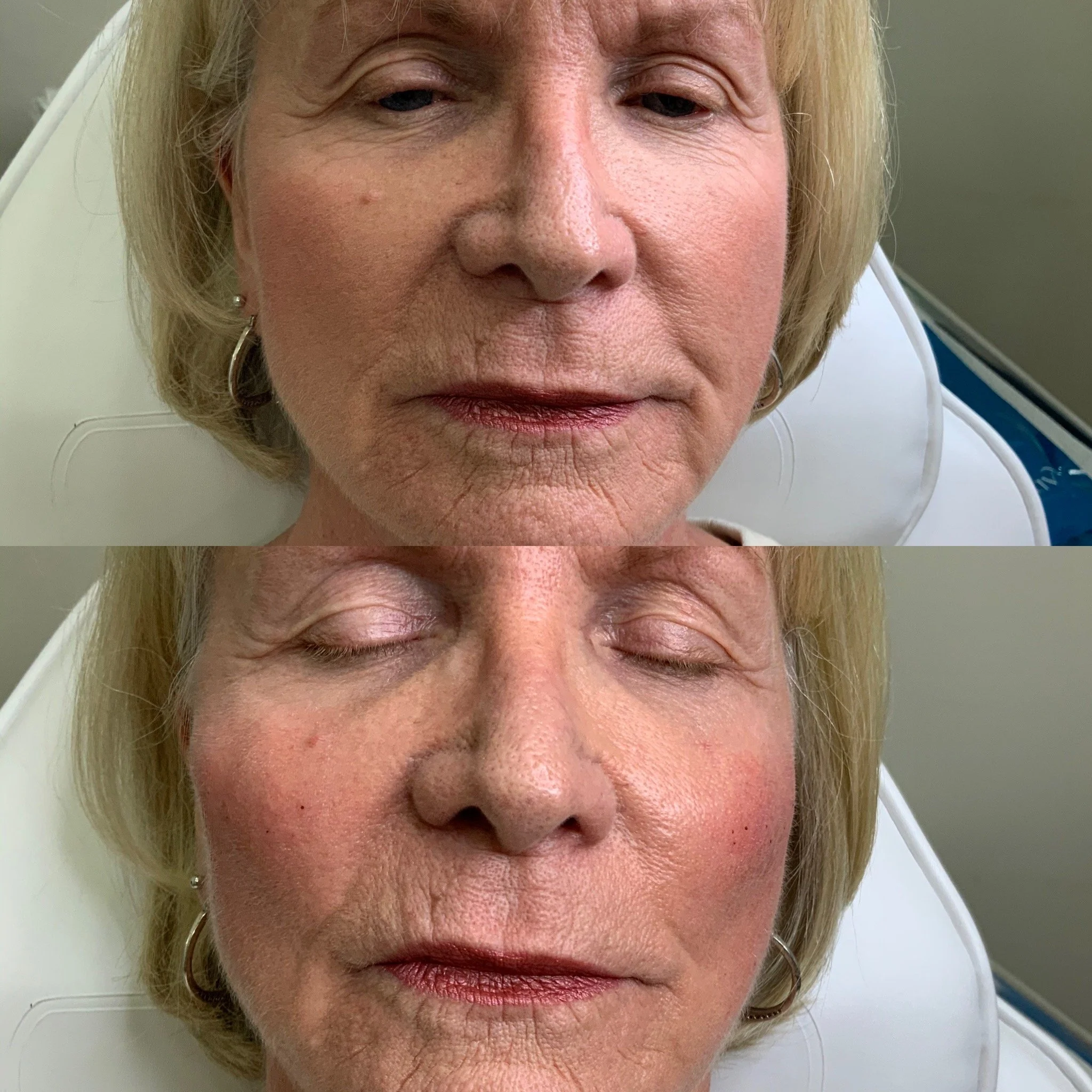 Cheek FIller