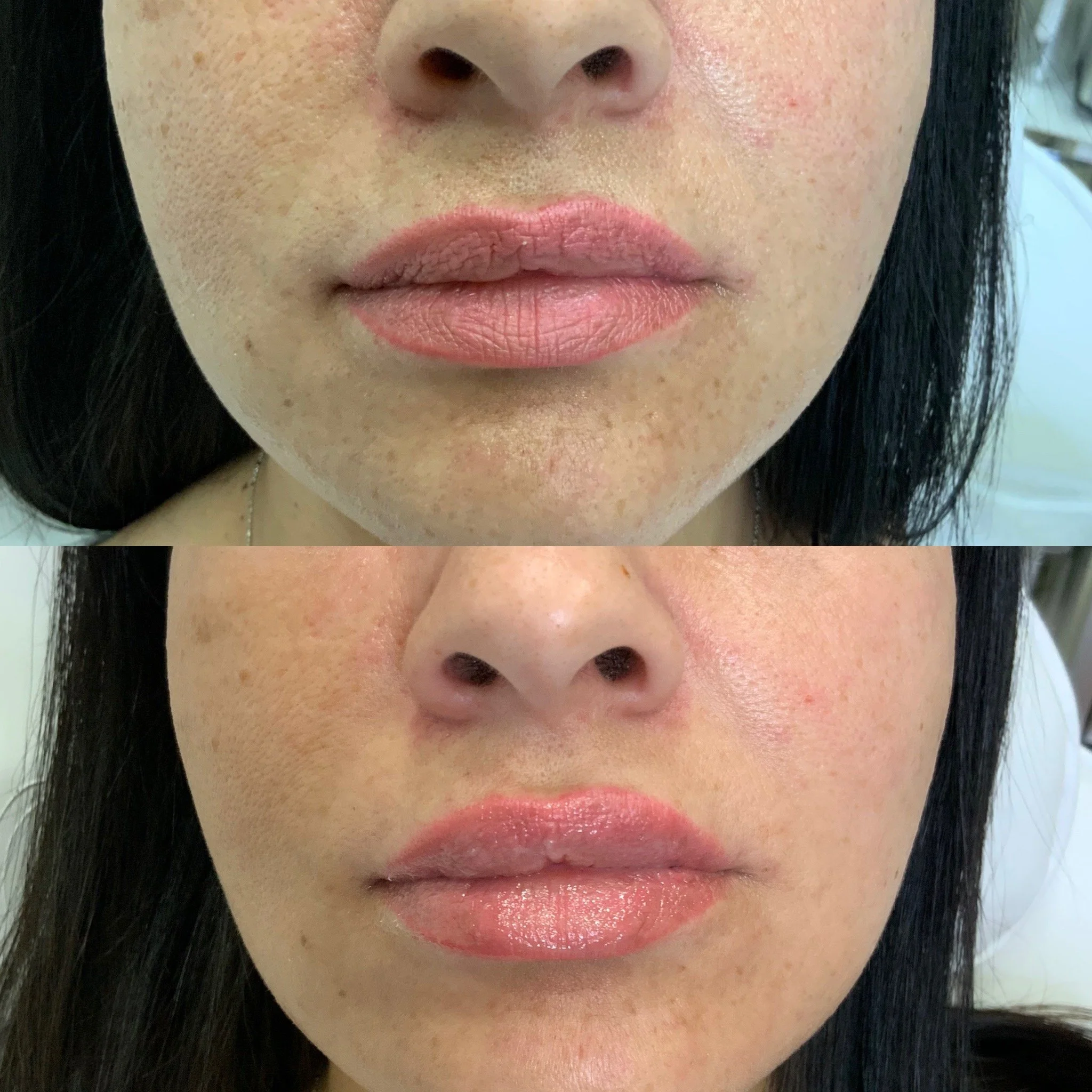 Lip FIller