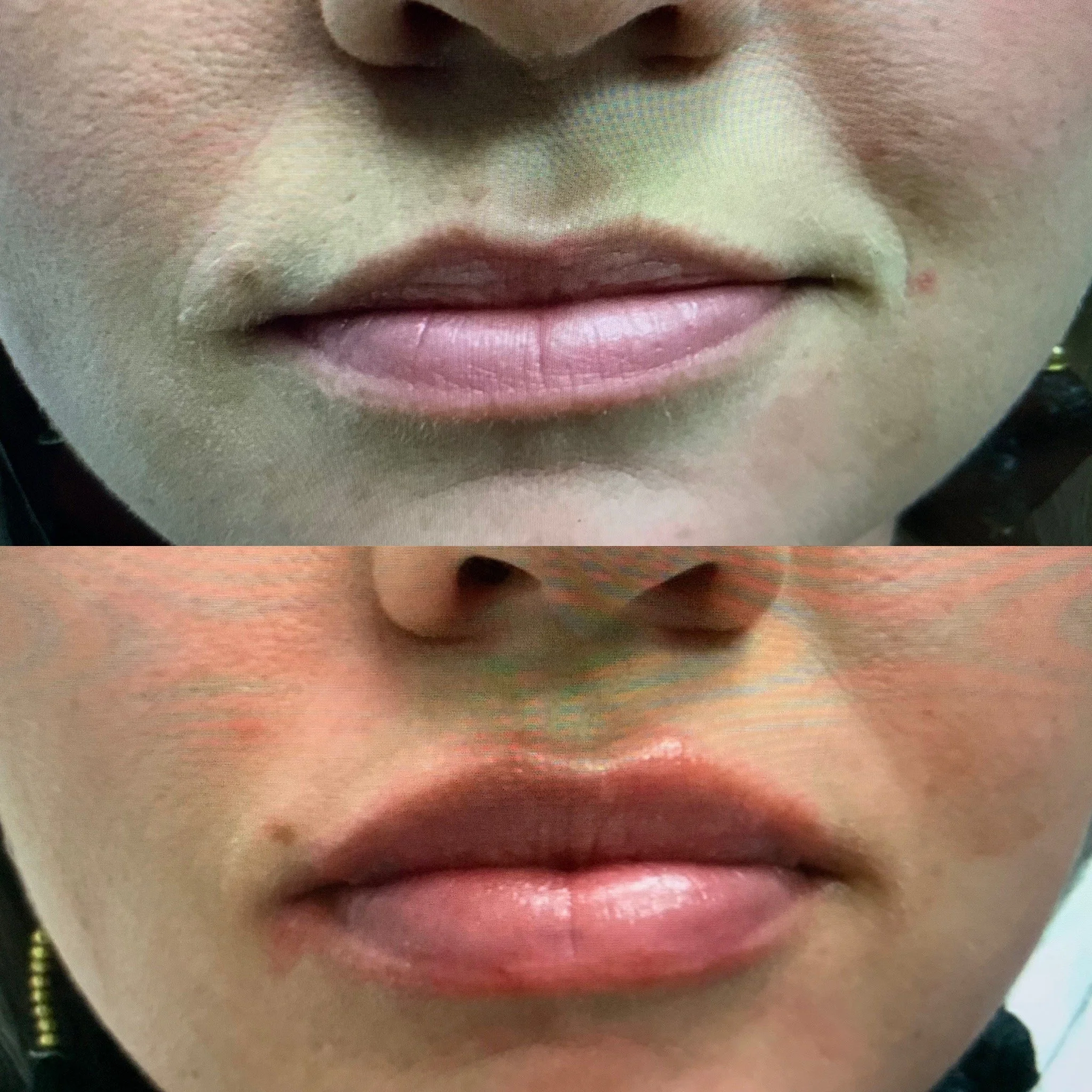 Lip Filler