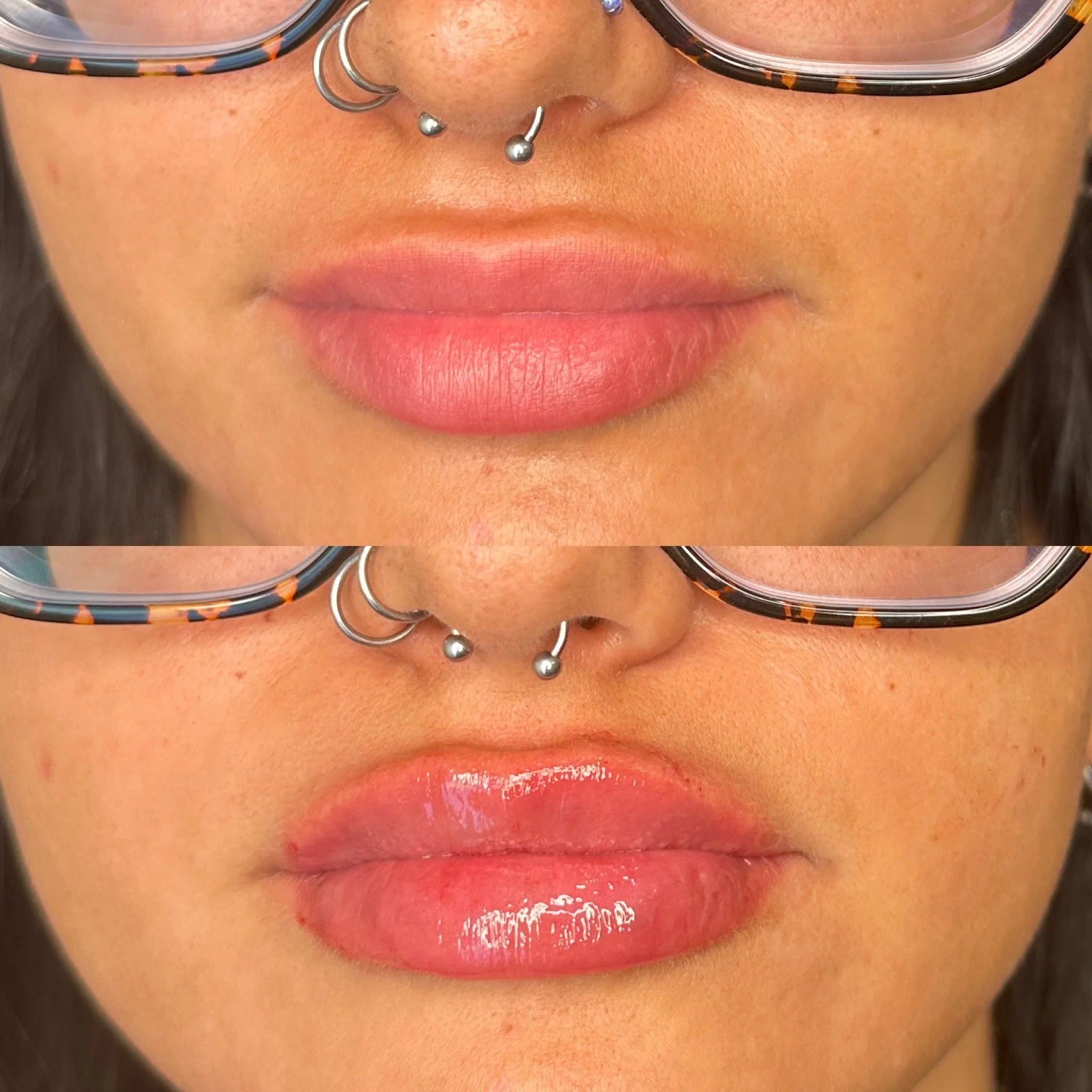 Lip Filler