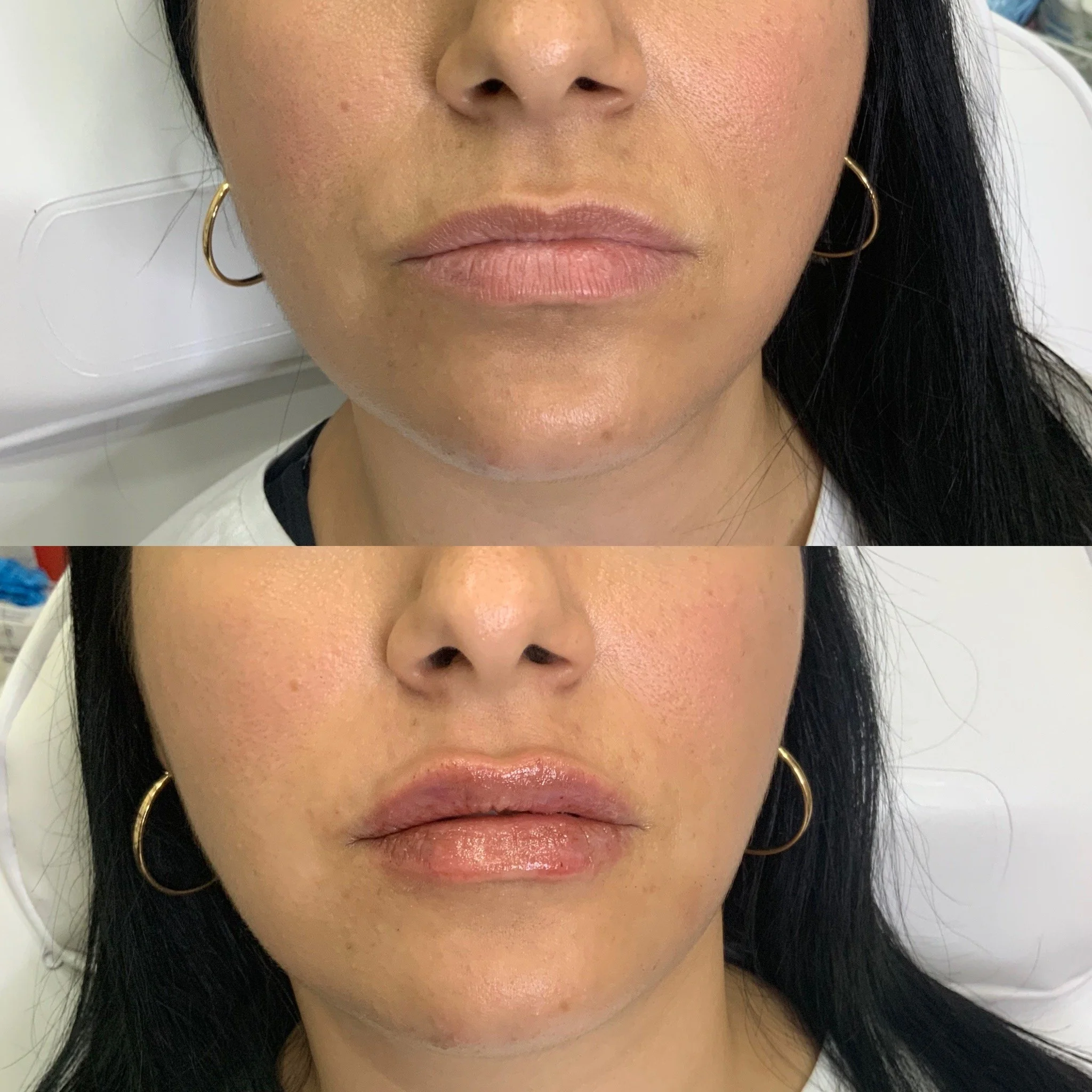 Lip FIller