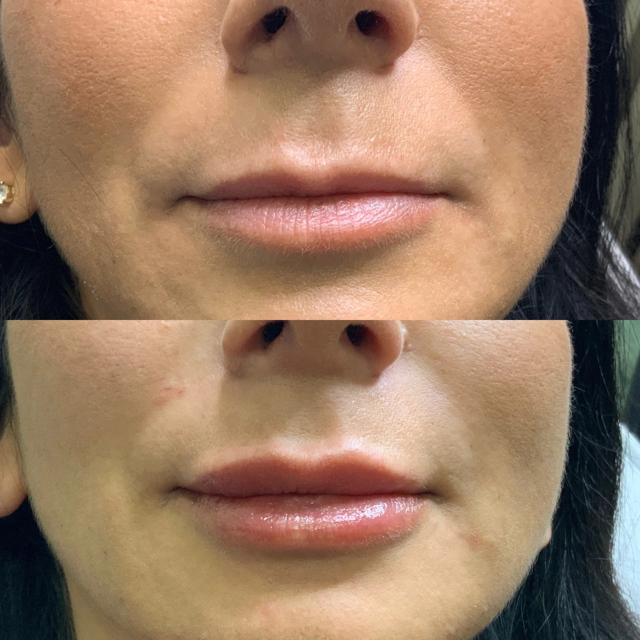 Lip Filler