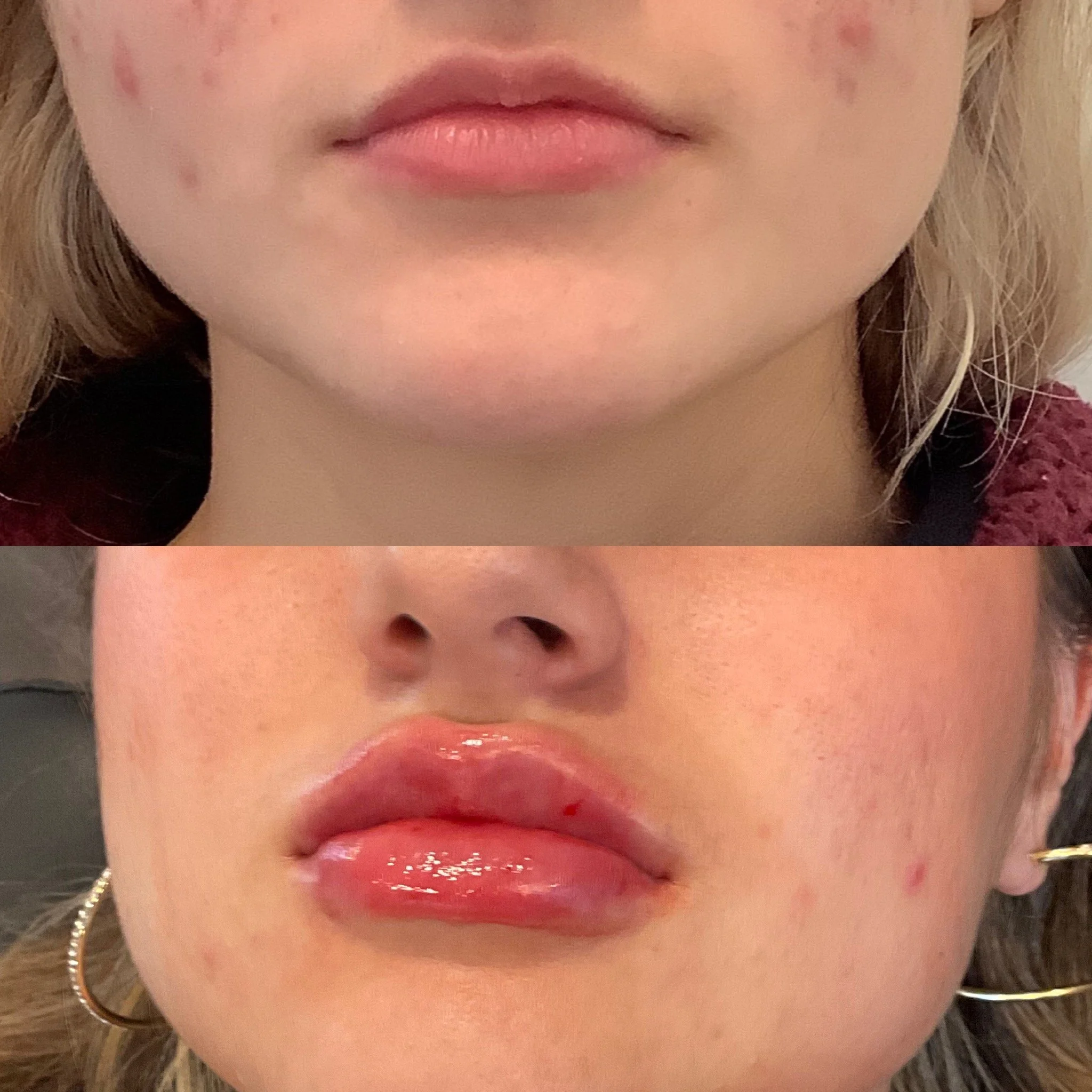 Lip Filler
