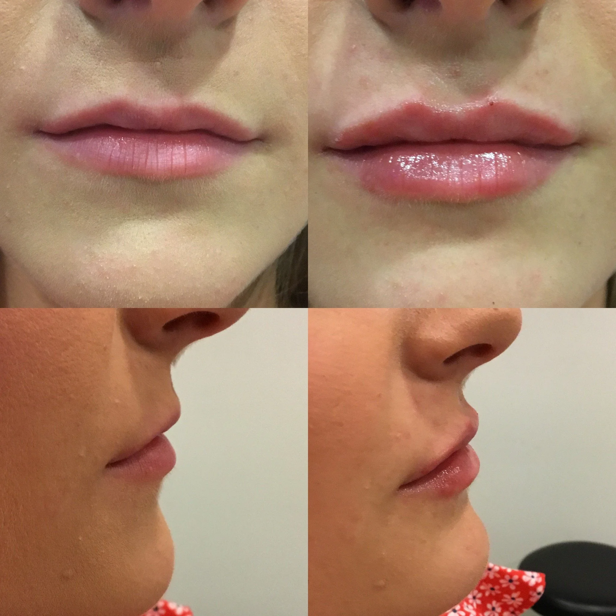 Lip Filler