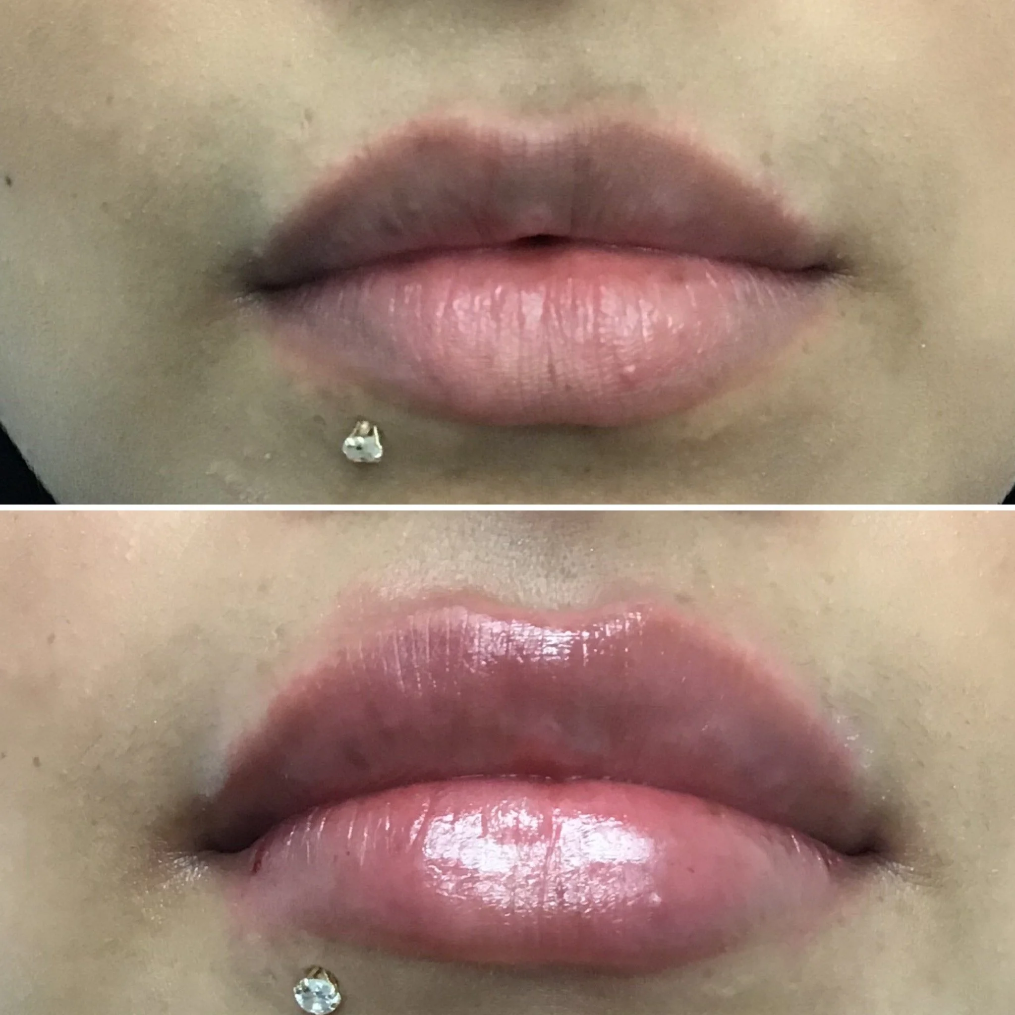 Lip Filler