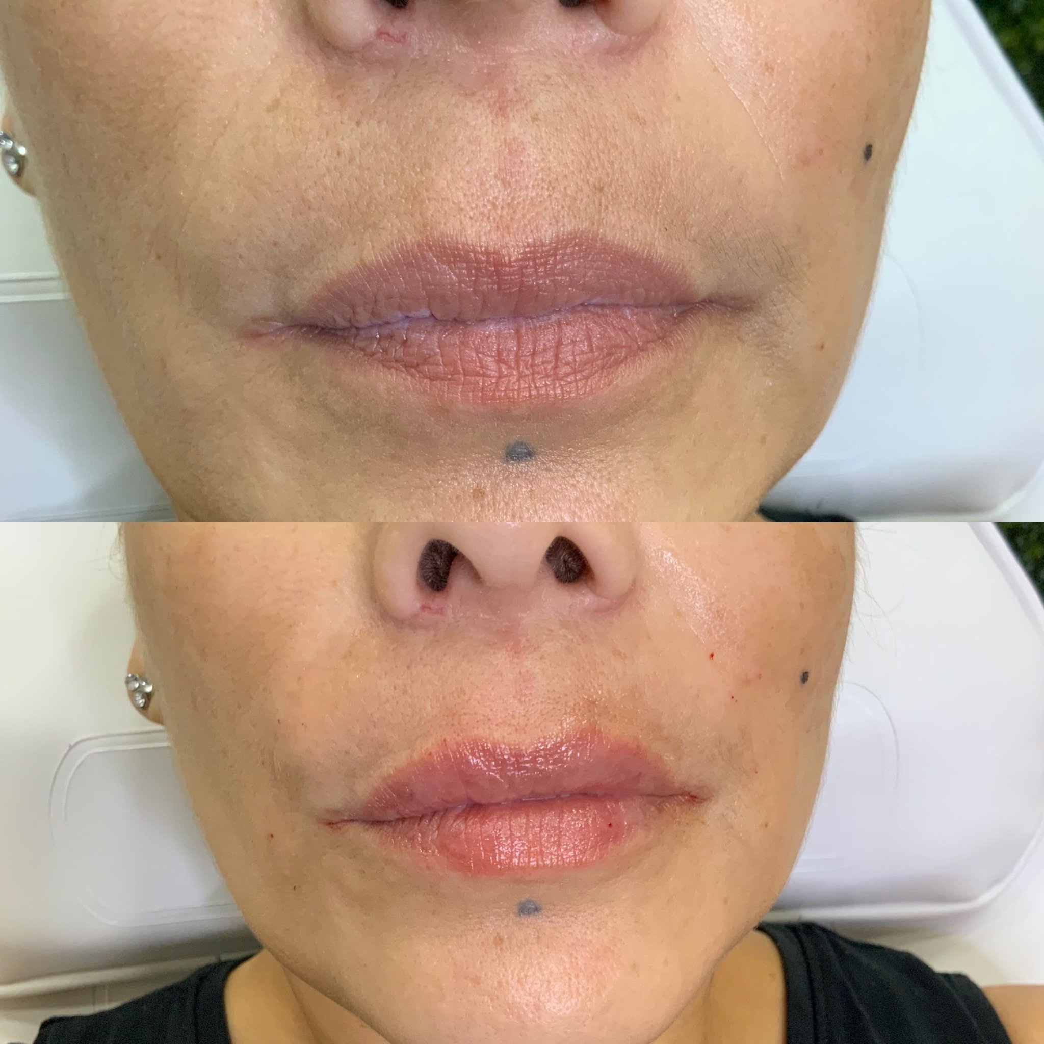Lip FIller