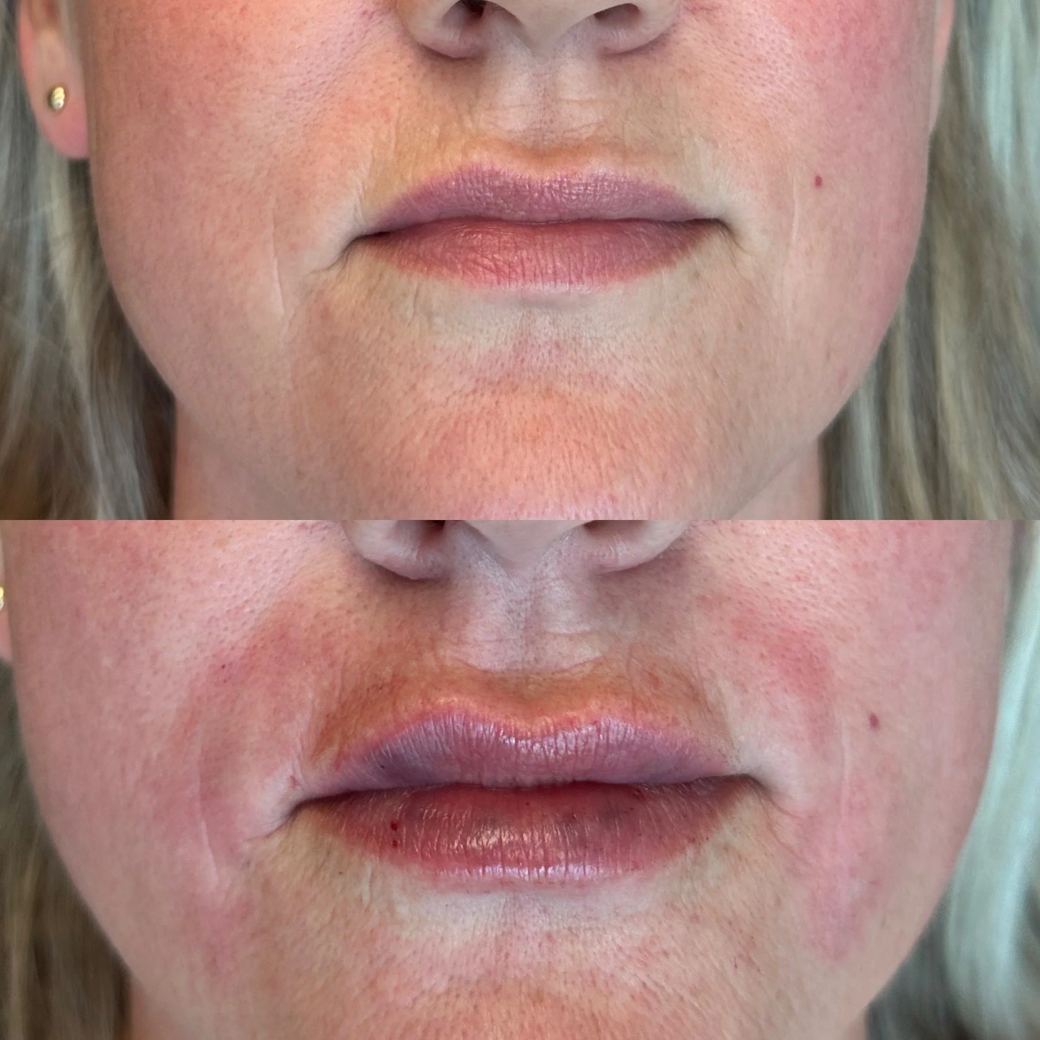 Smile Line Filler 1 syringe
