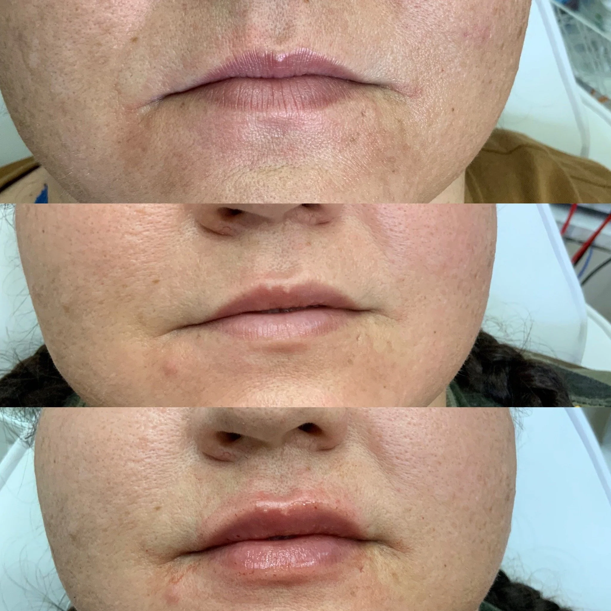 Lip FIller building over multiple sessions 