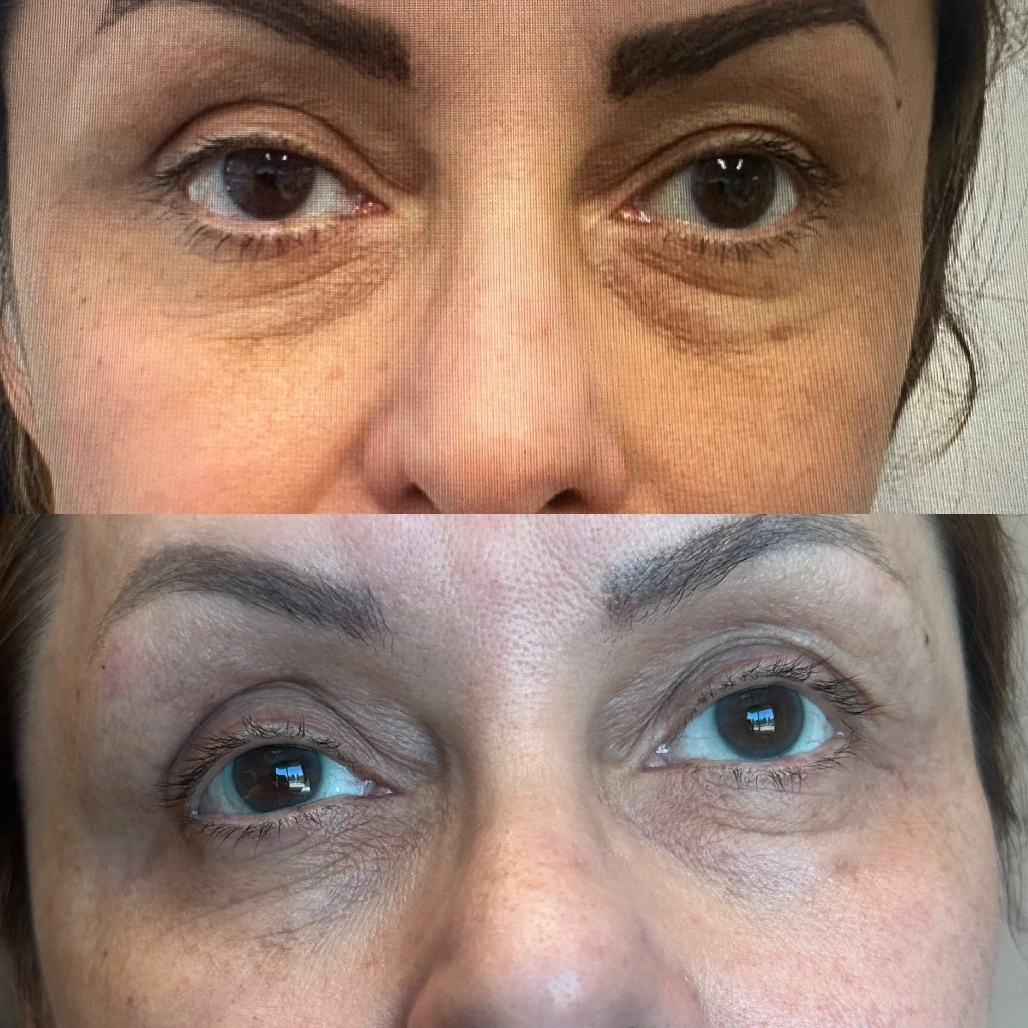 Under Eye Treatment