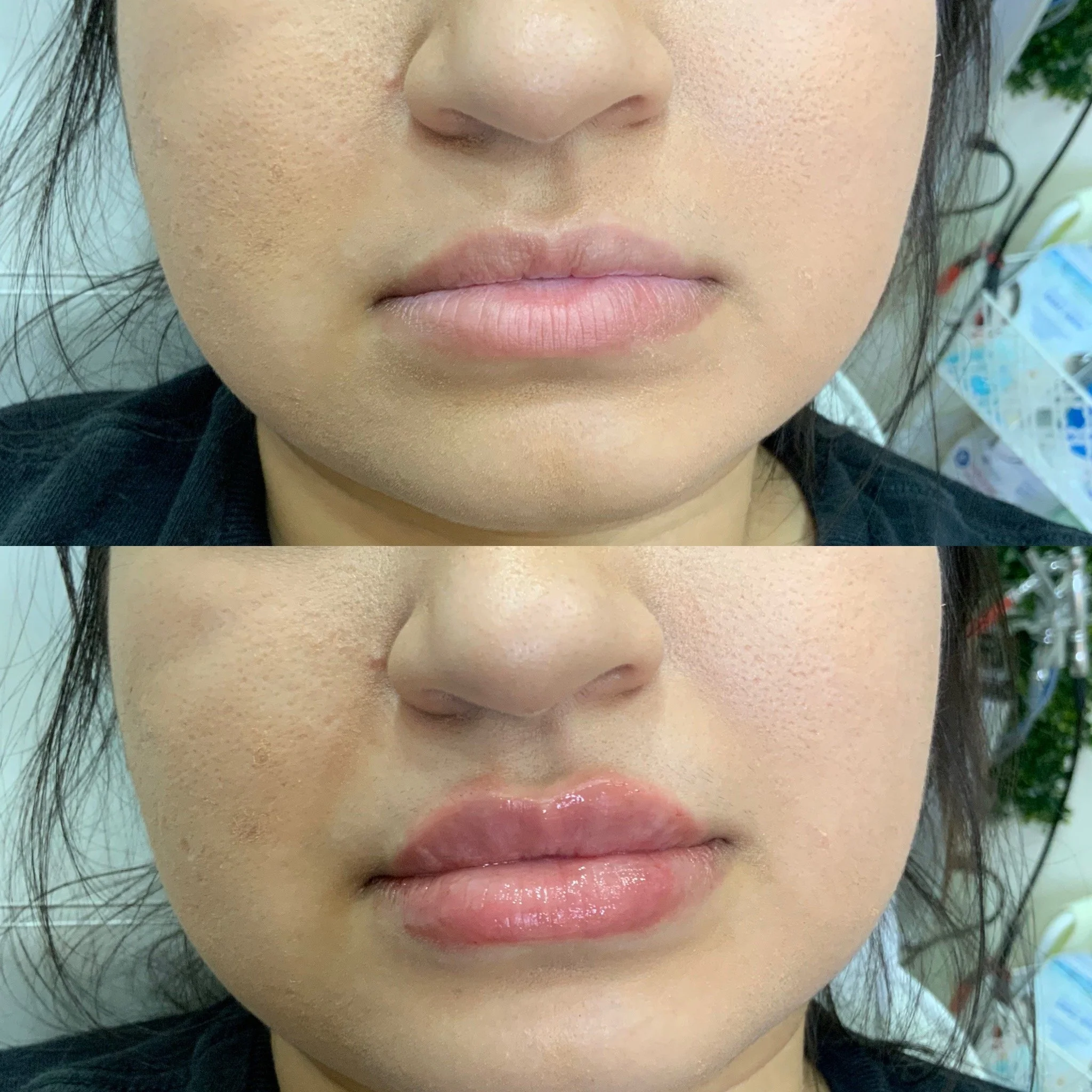 Lip Filler