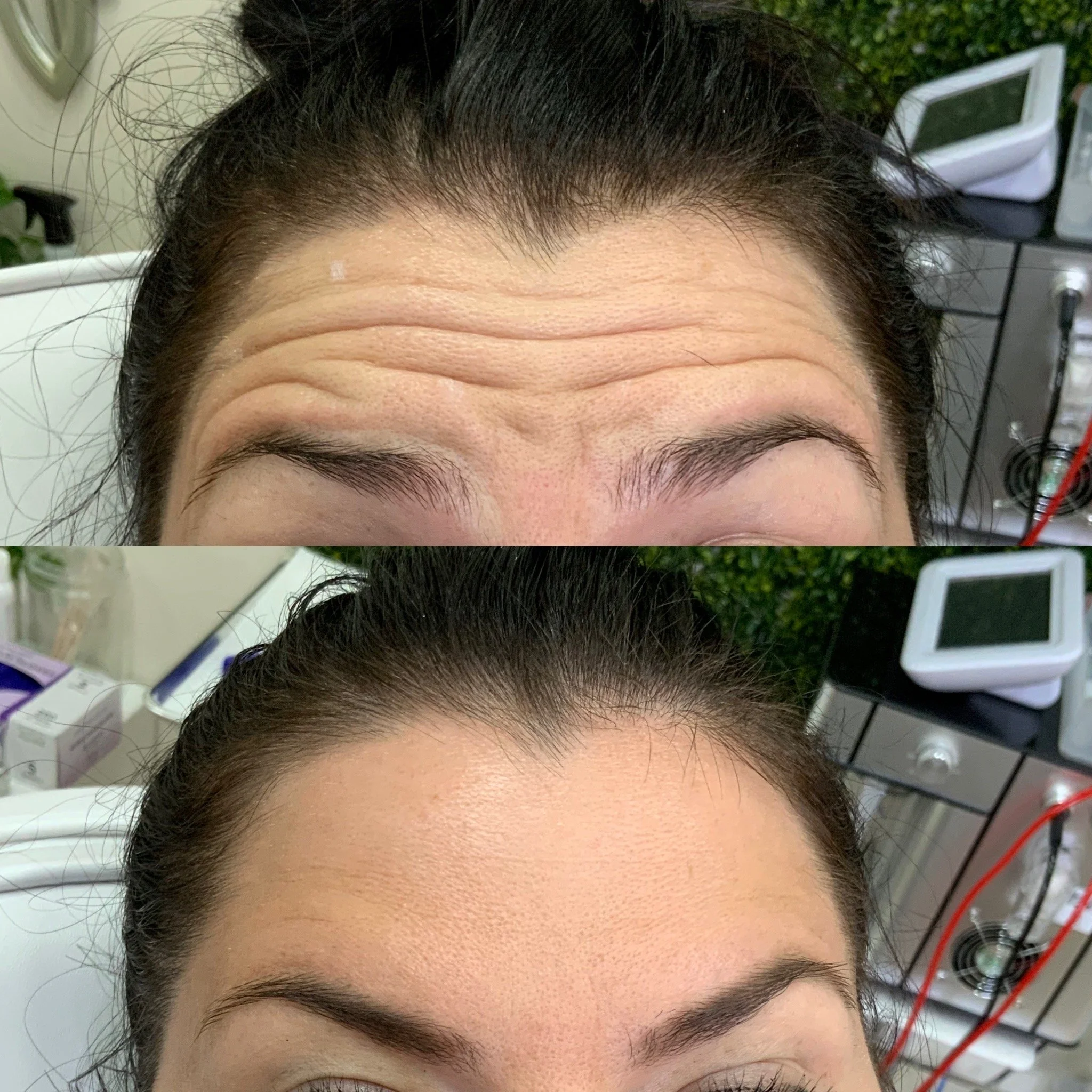 Forehead Neurotoxin