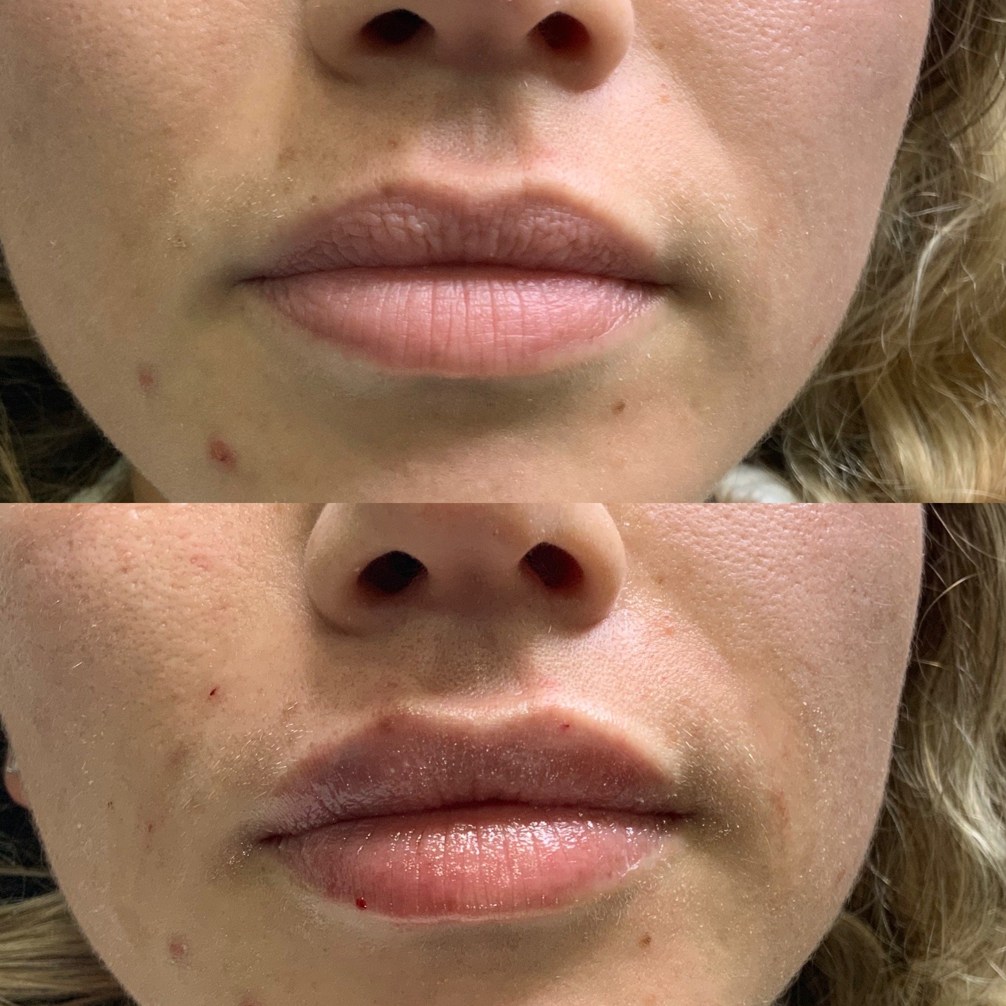 Lip Filler