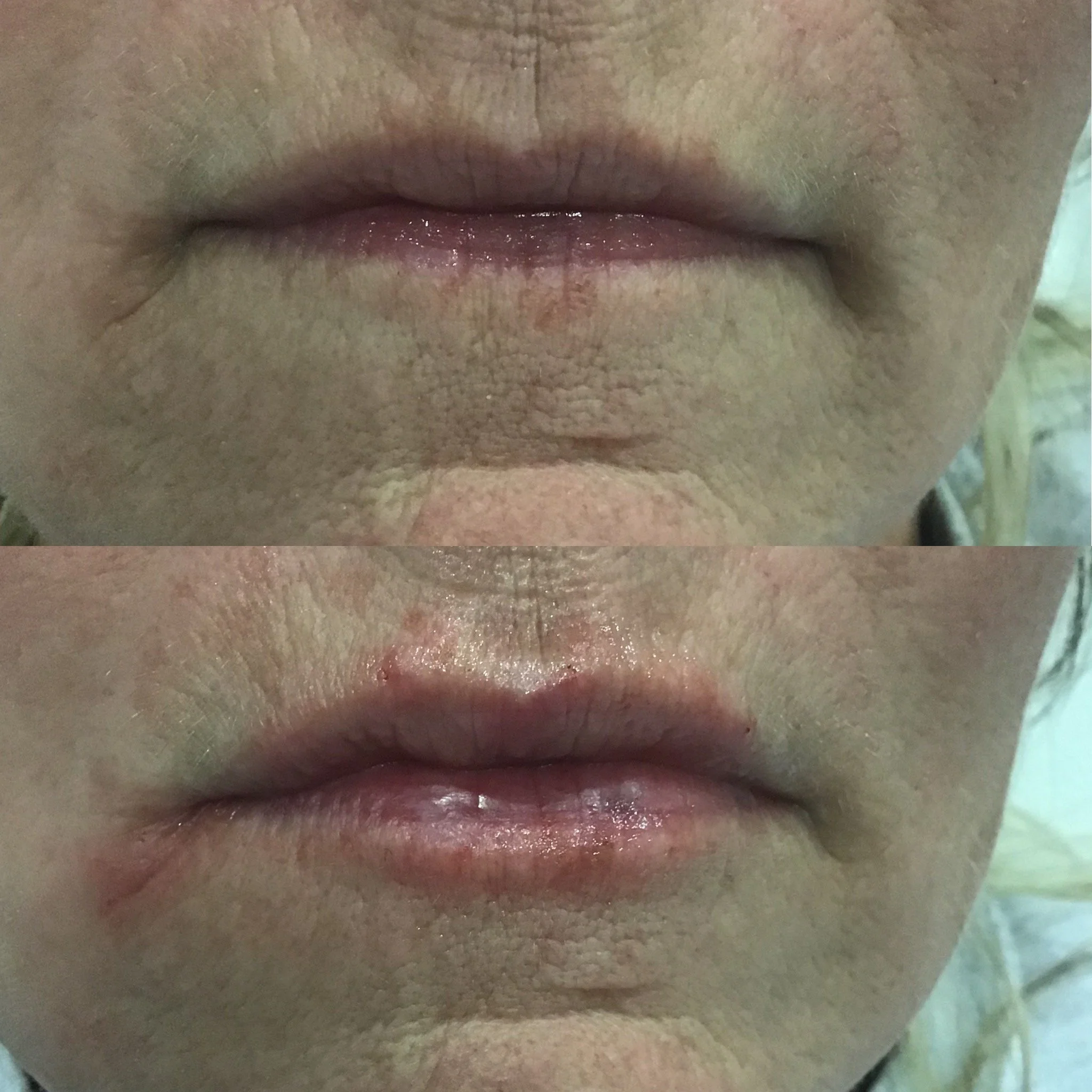 Lip Filler