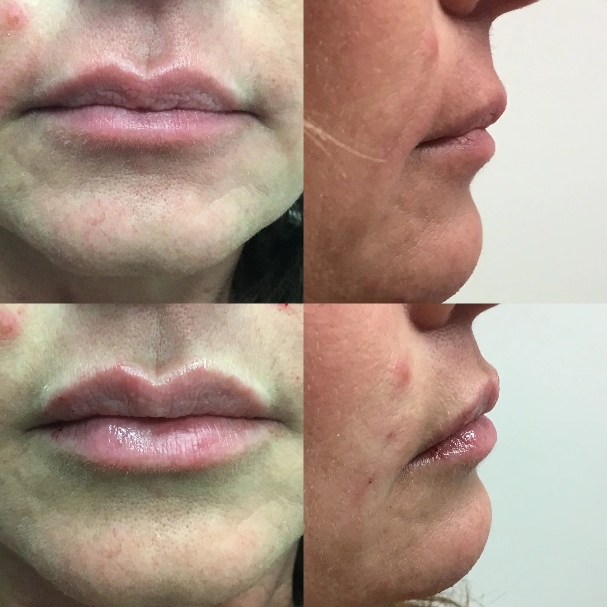 Lip Filler