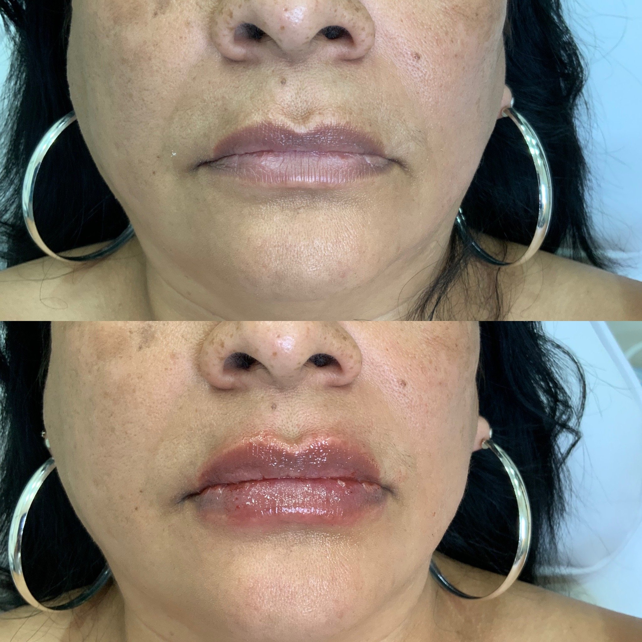 Lip FIller