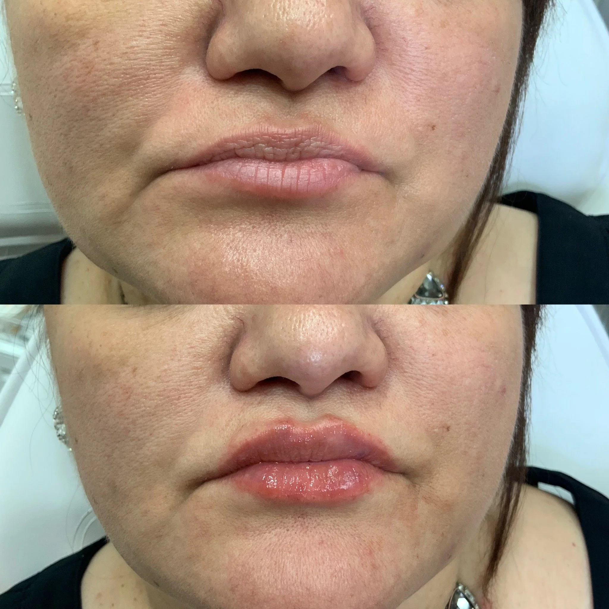 Lip FIller