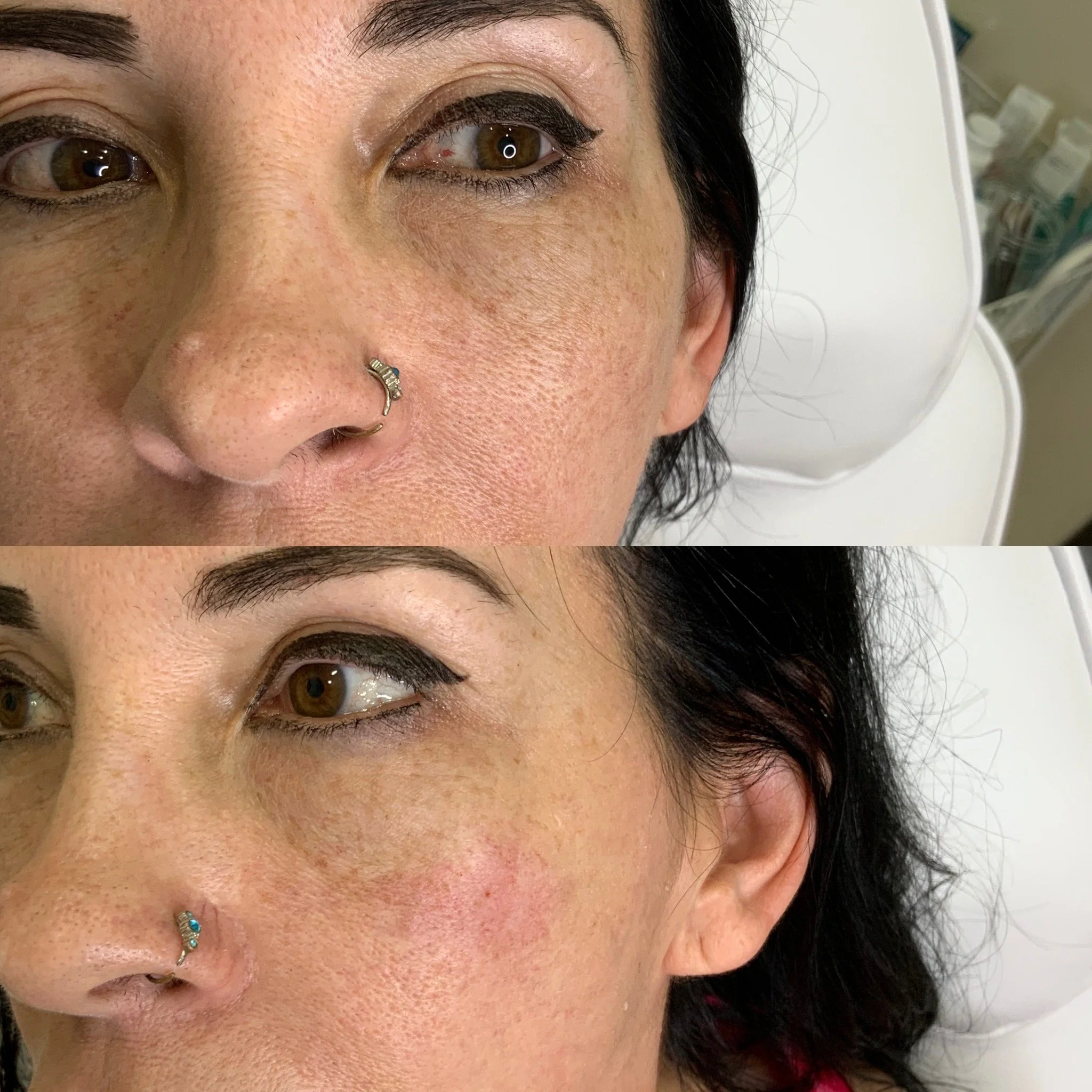 Under Eye Treatment