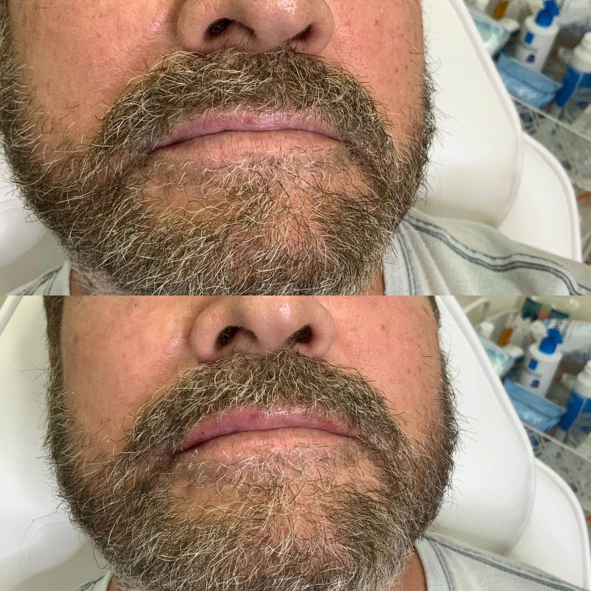 Lip FIller
