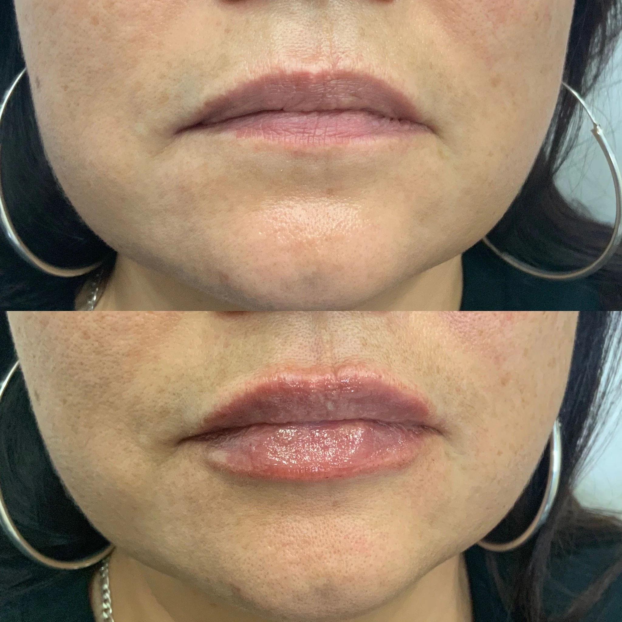 Lip FIller