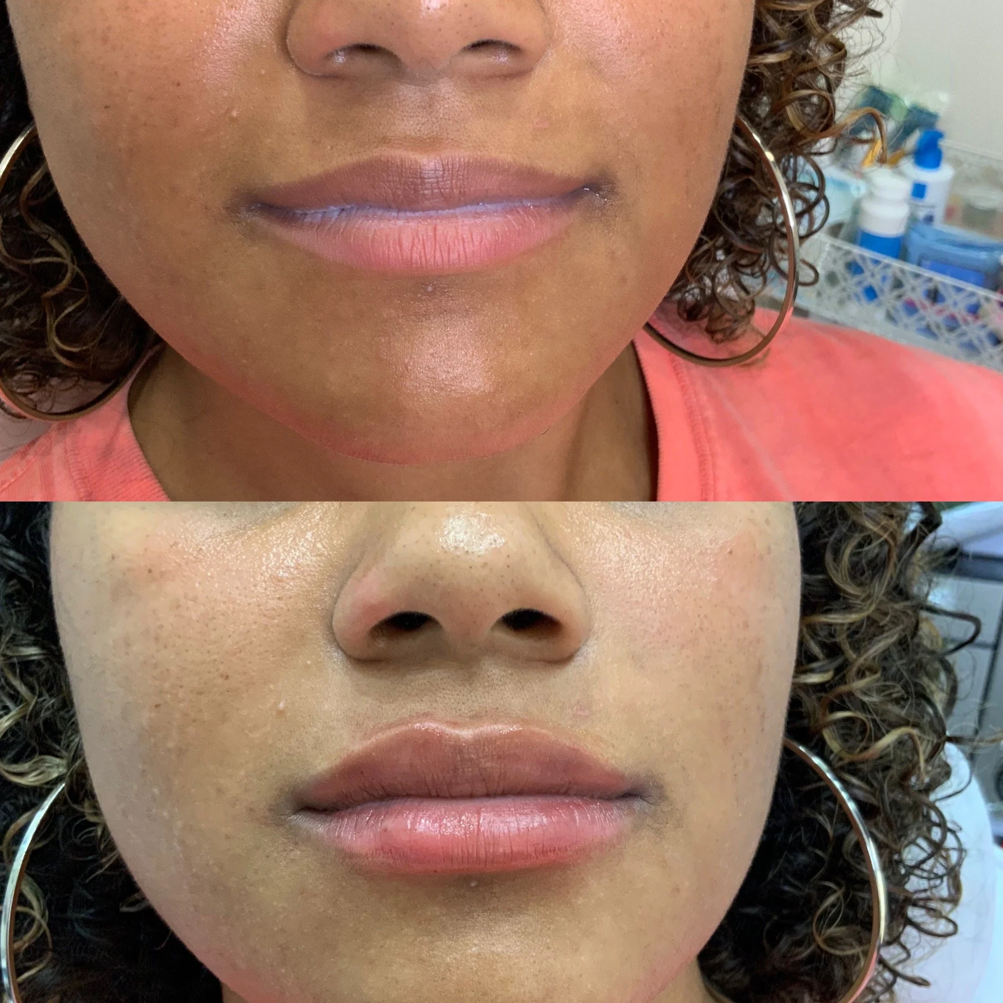 Lip Filler