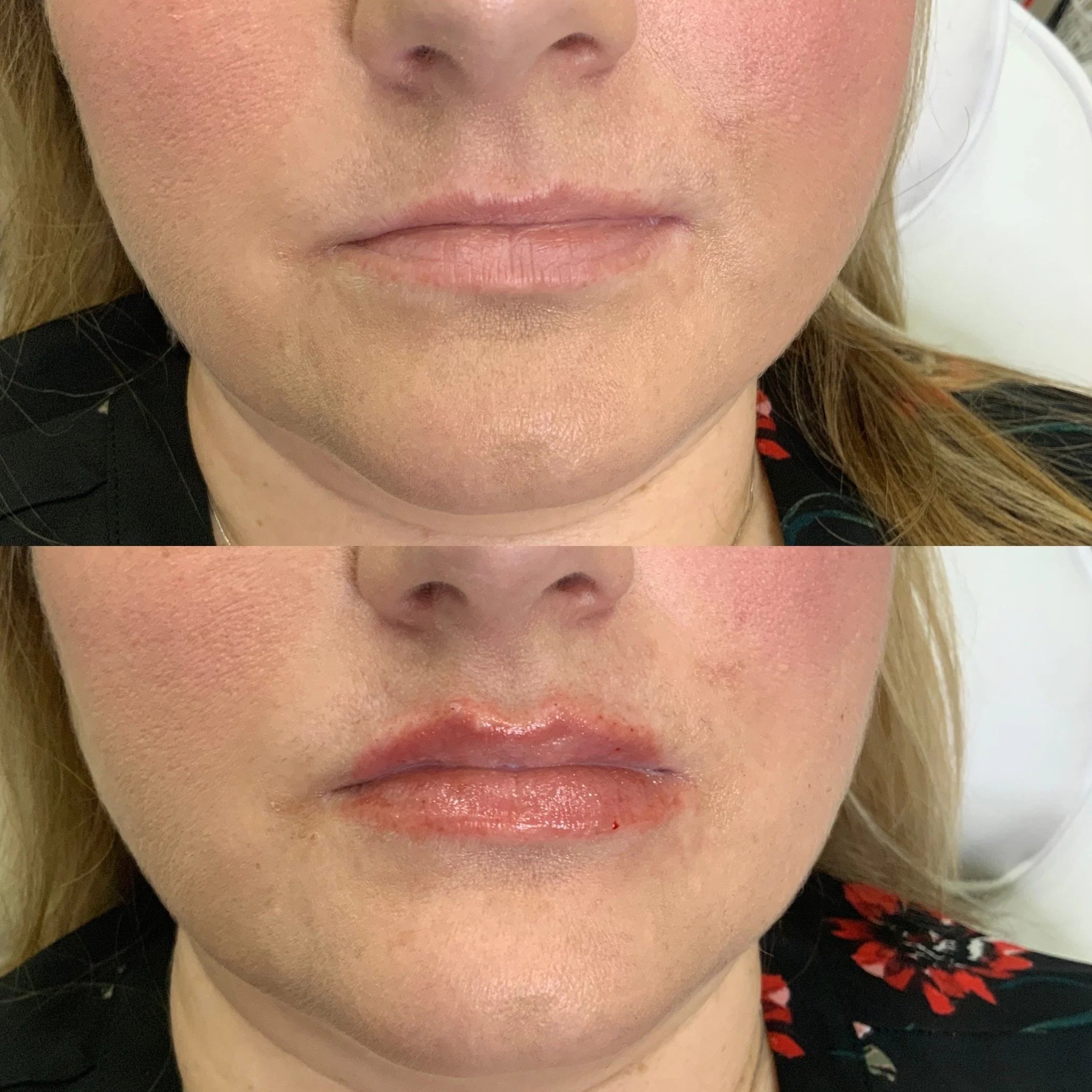 Lip FIller
