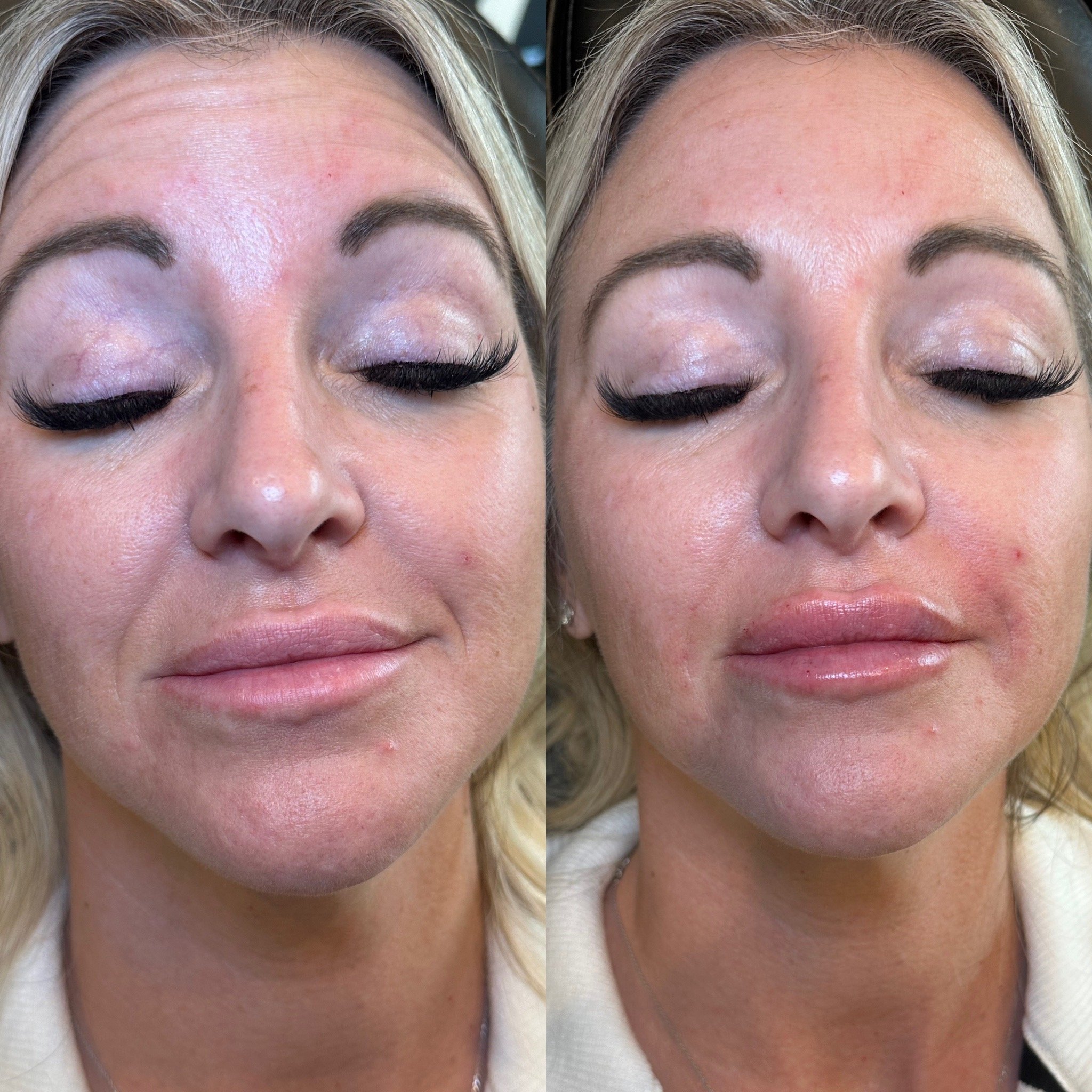Lip and Smile line Filler