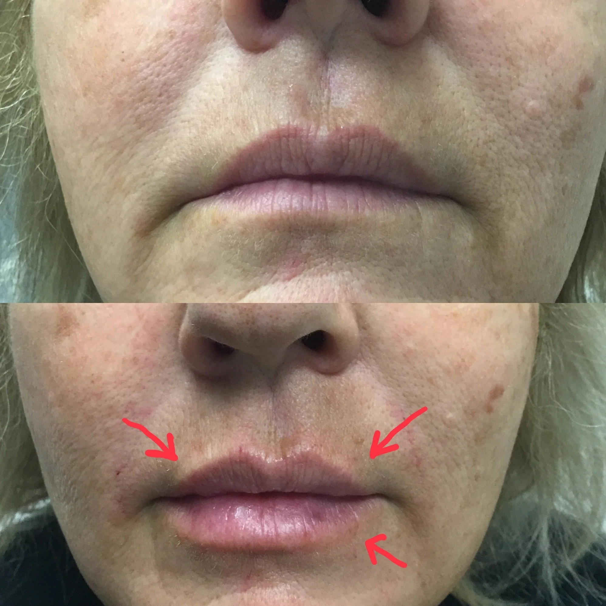 Lip Filler