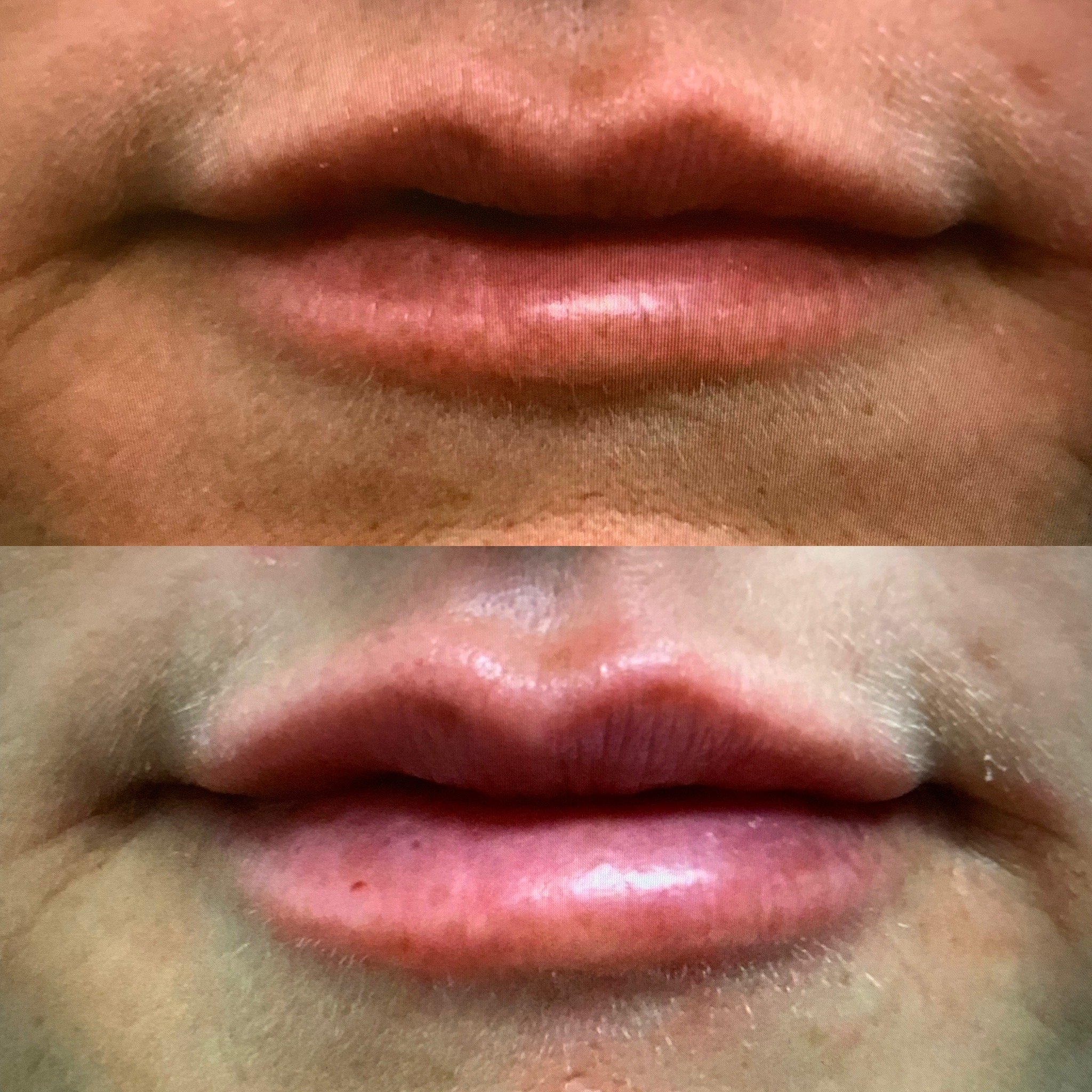 Lip Filler
