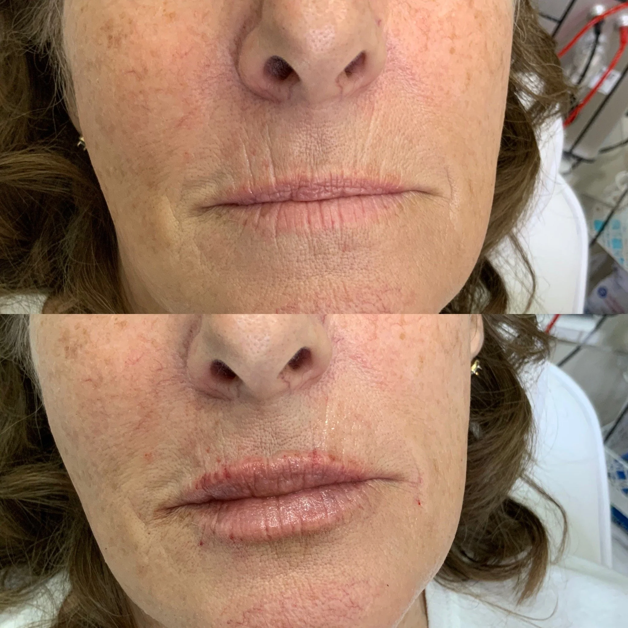 Lip FIller and vertical line work around mouth