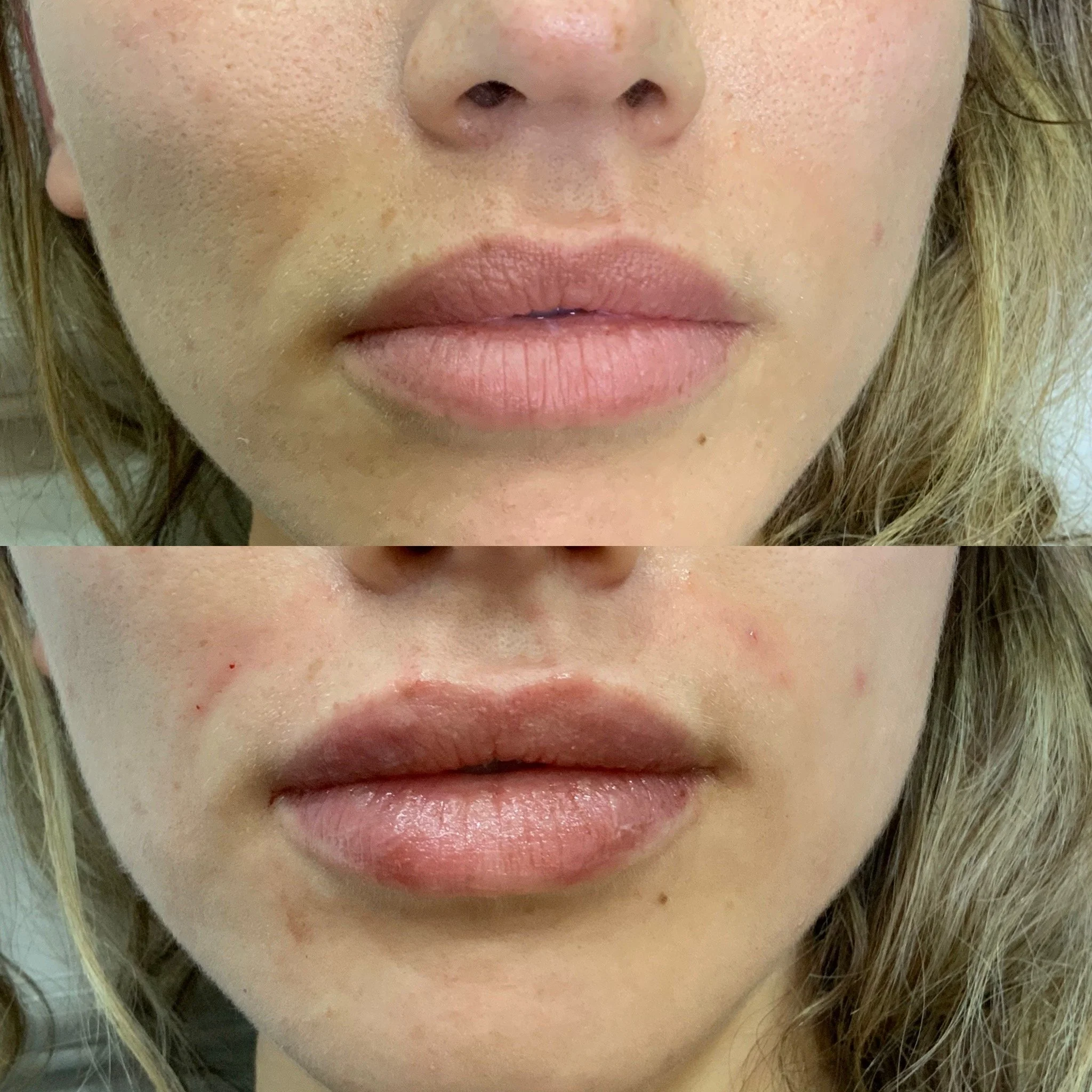 Lip FIller and Smile line filler