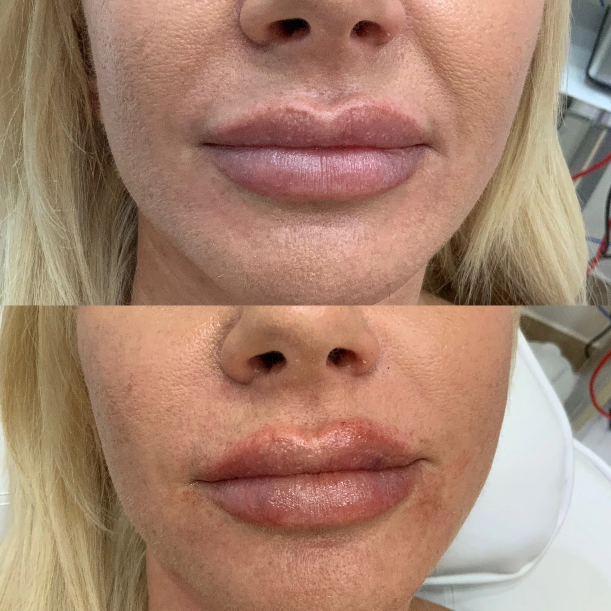 Lip FIller
