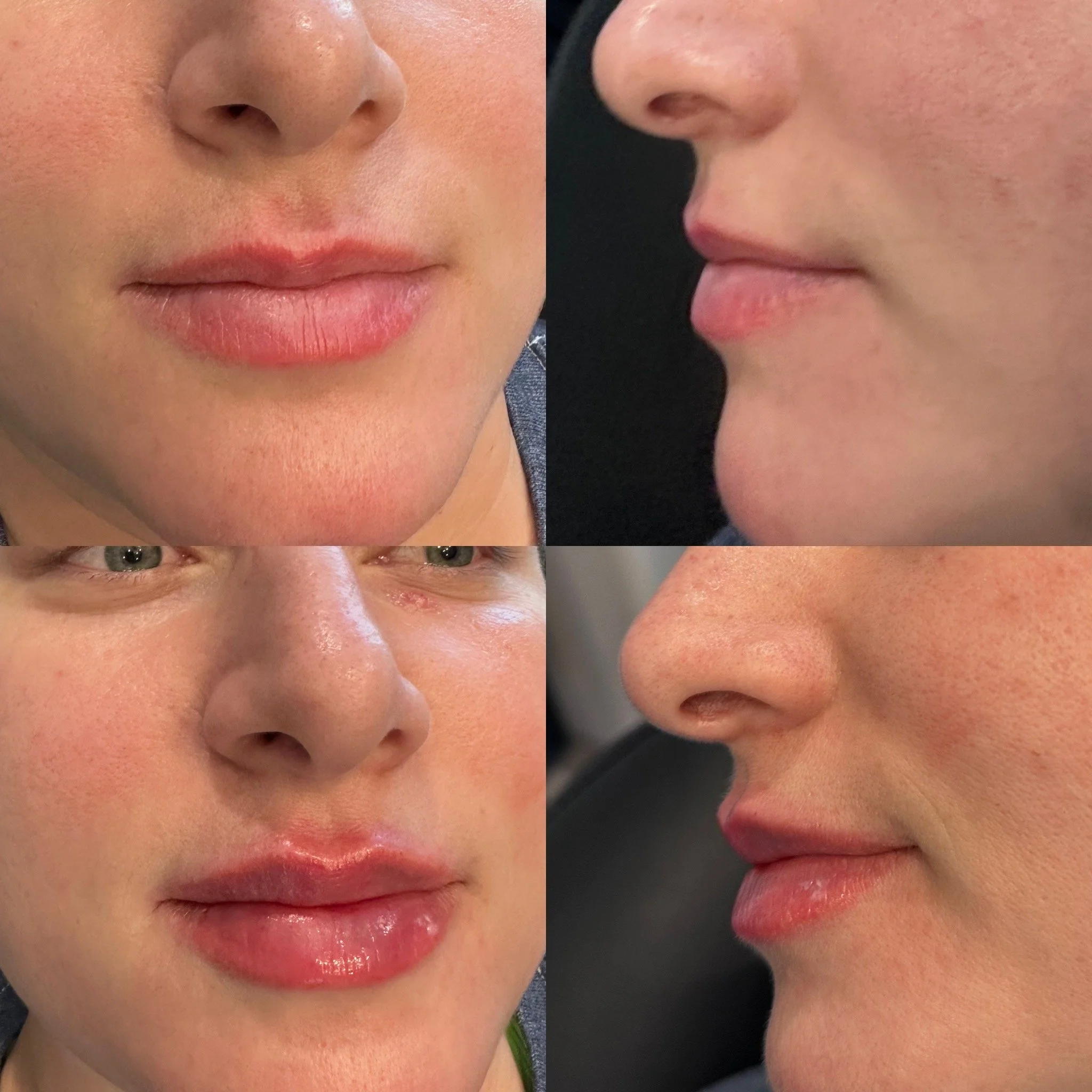 Lip Filler