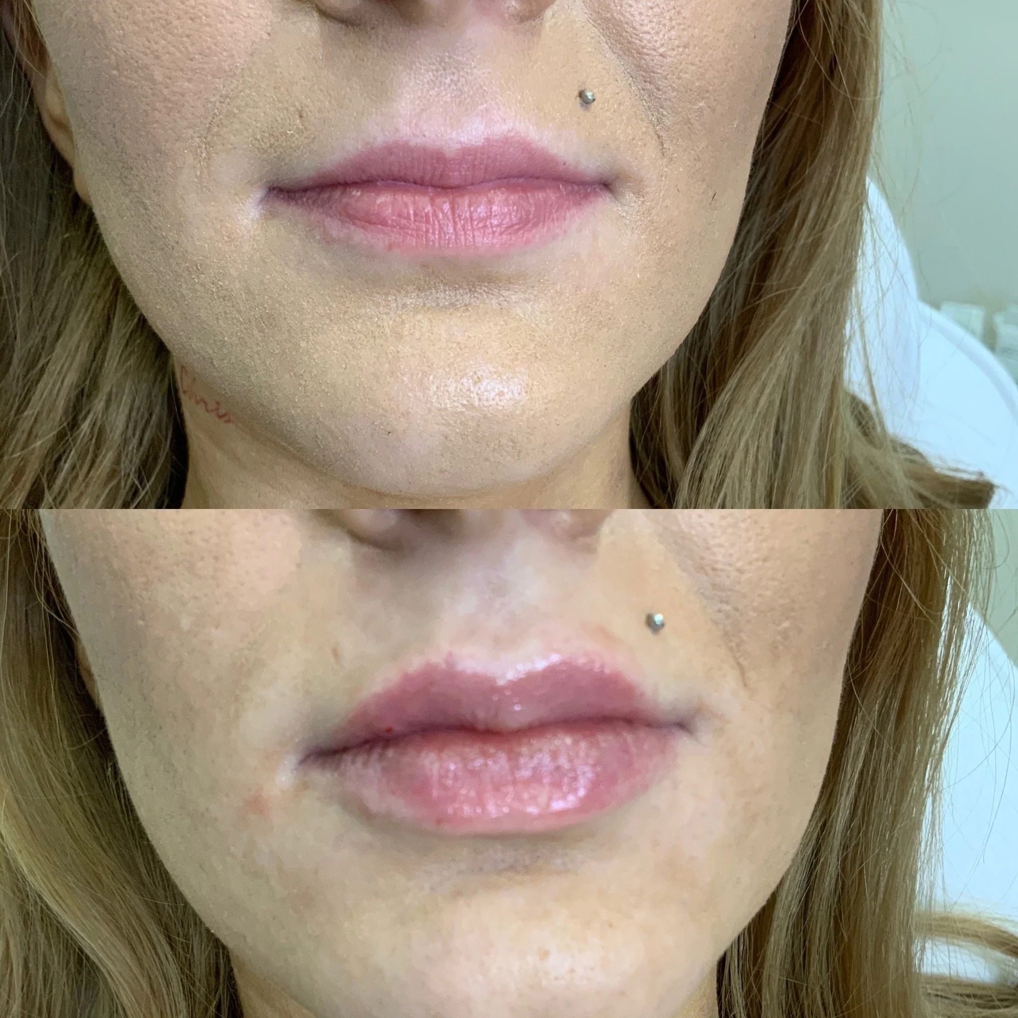Lip Filler