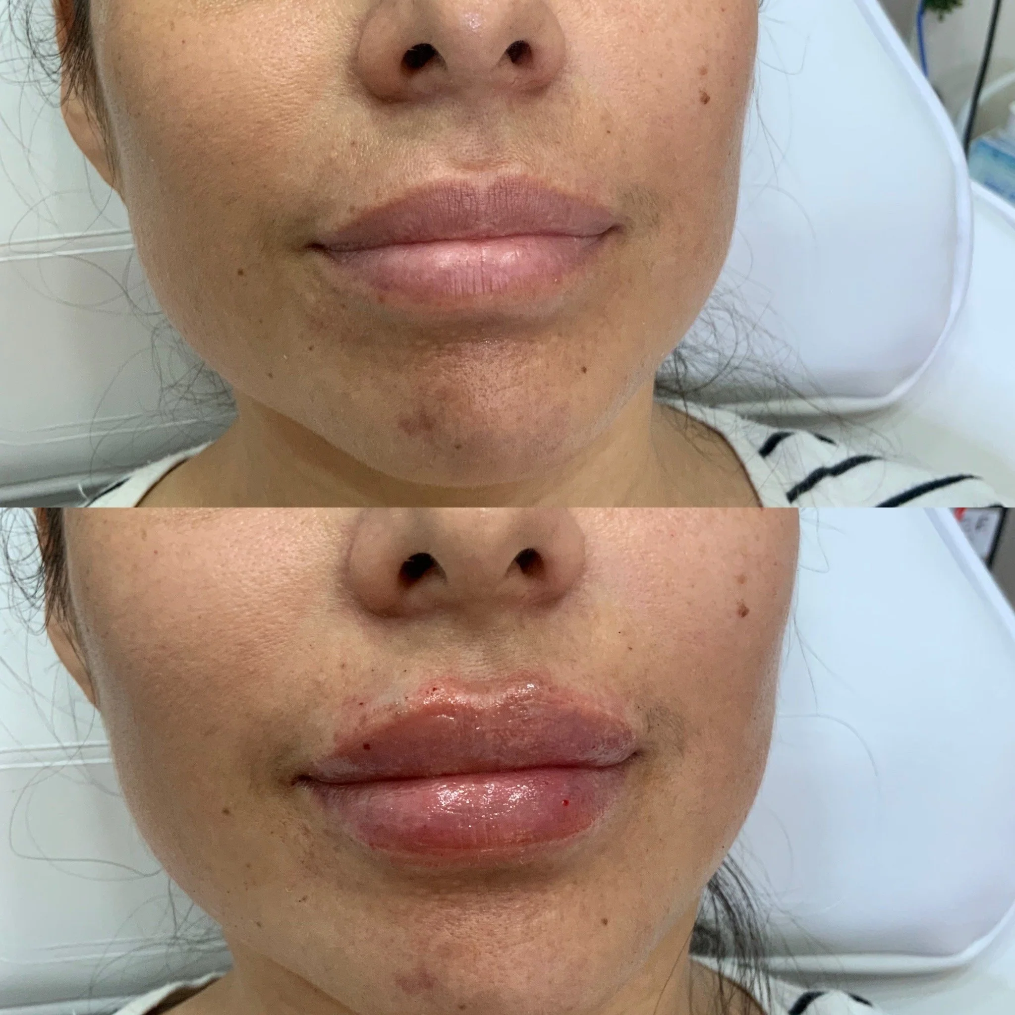 Lip FIller