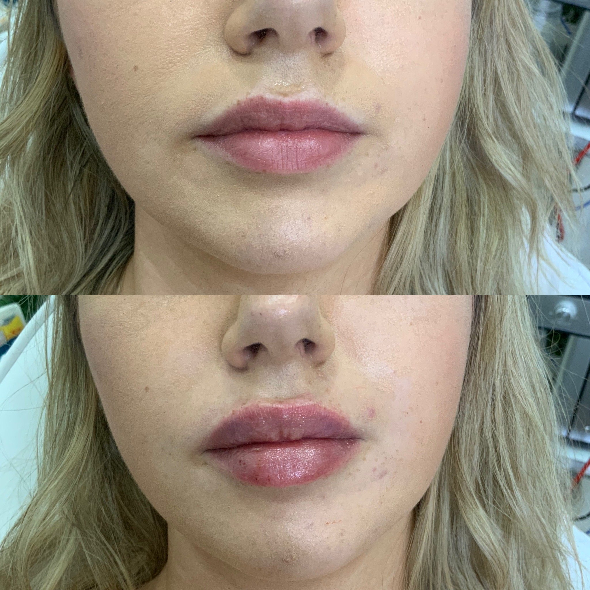 Lip Filler