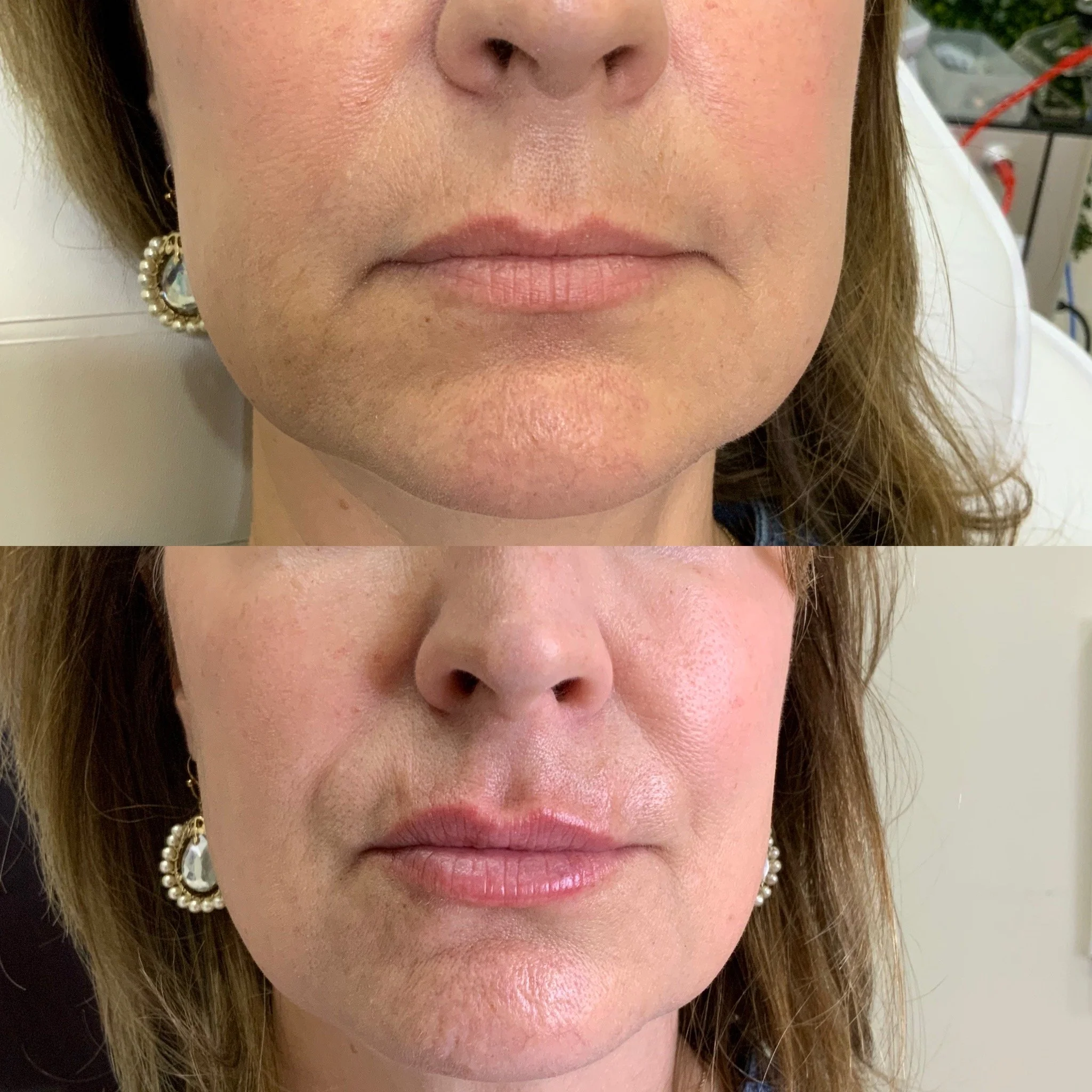 Lip FIller
