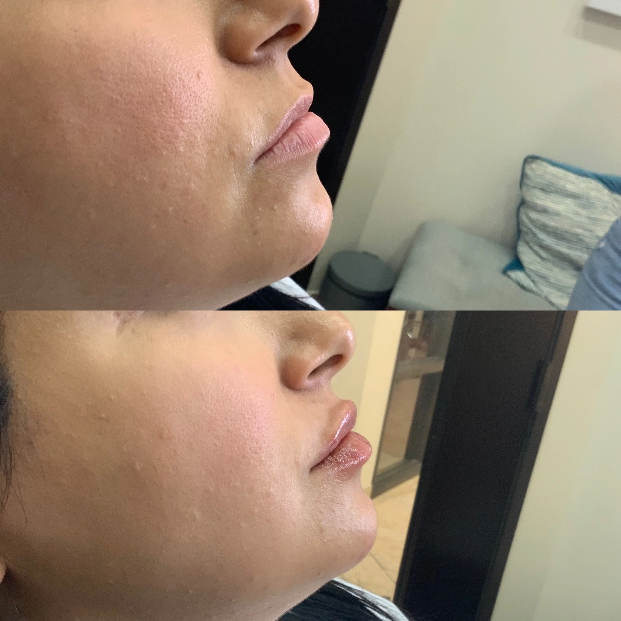 Lip Filler