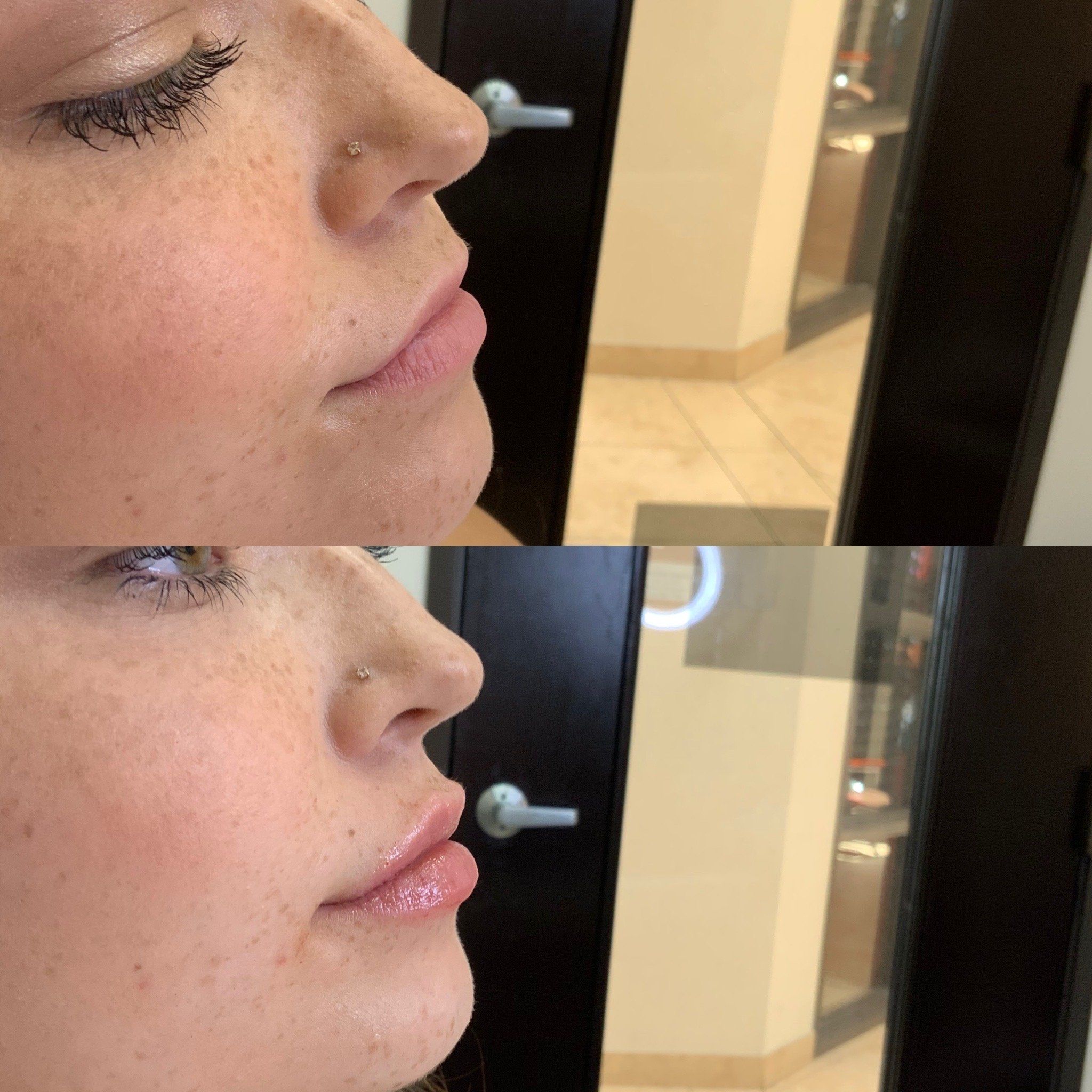 Lip FIller