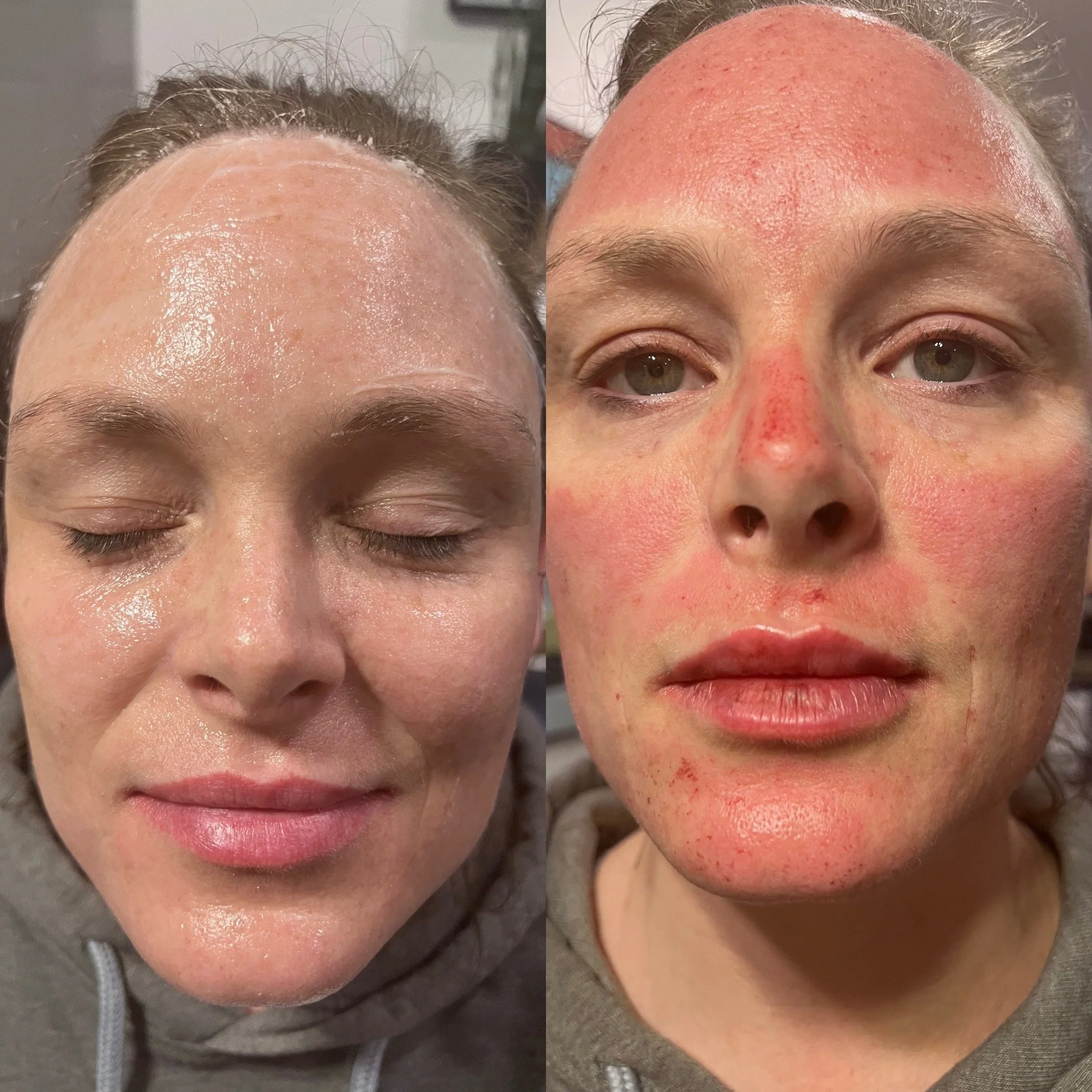 Microneedling with PRP/PDRN