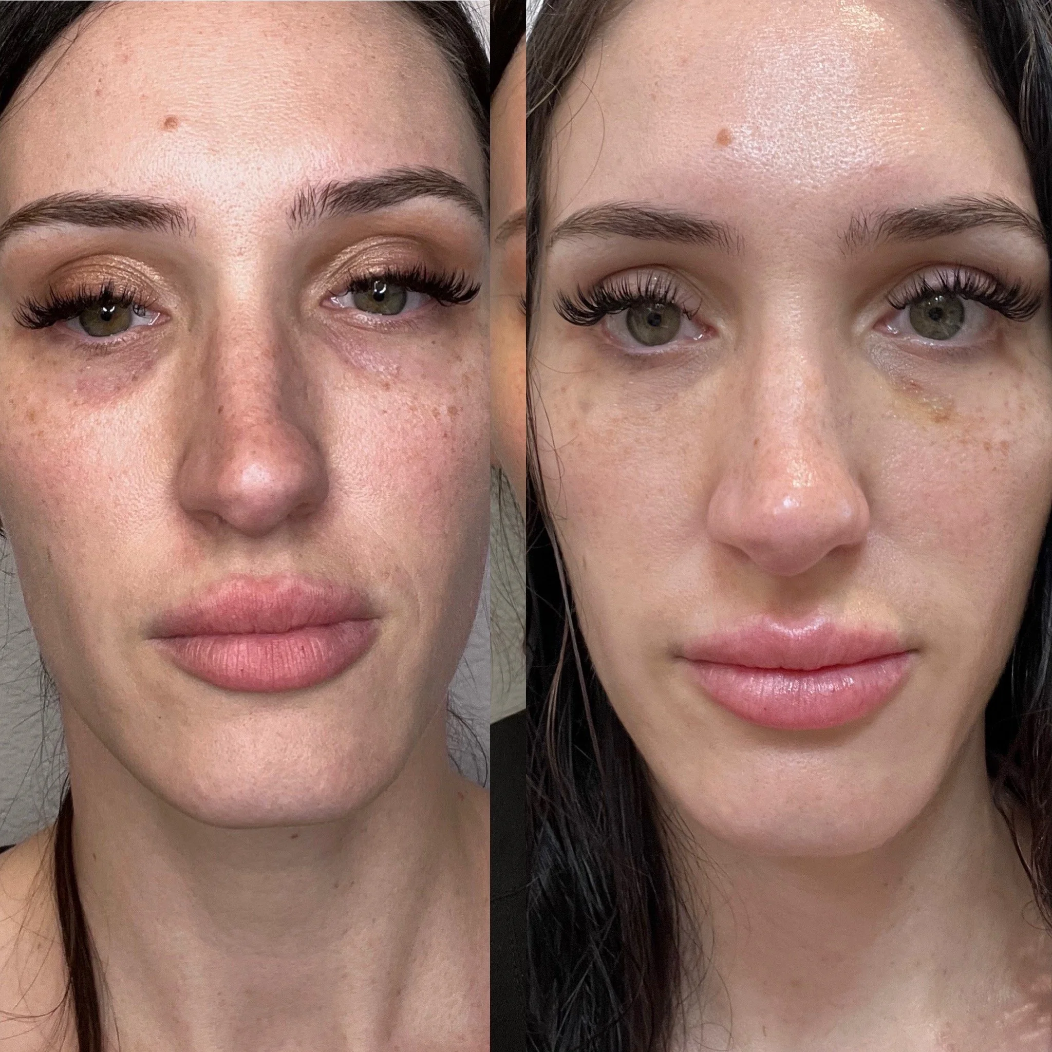 PRP/PRF Injectable