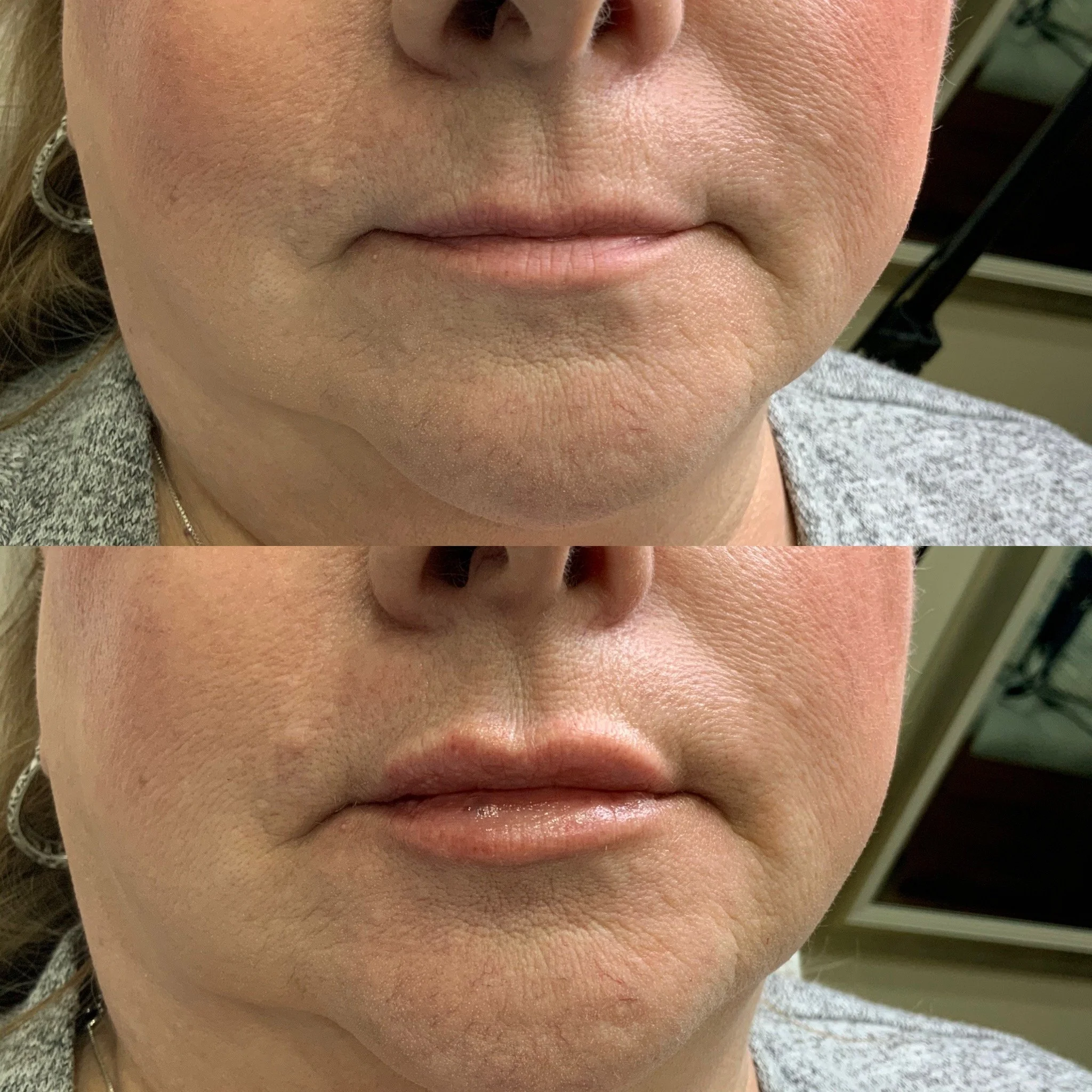 Lip Filler