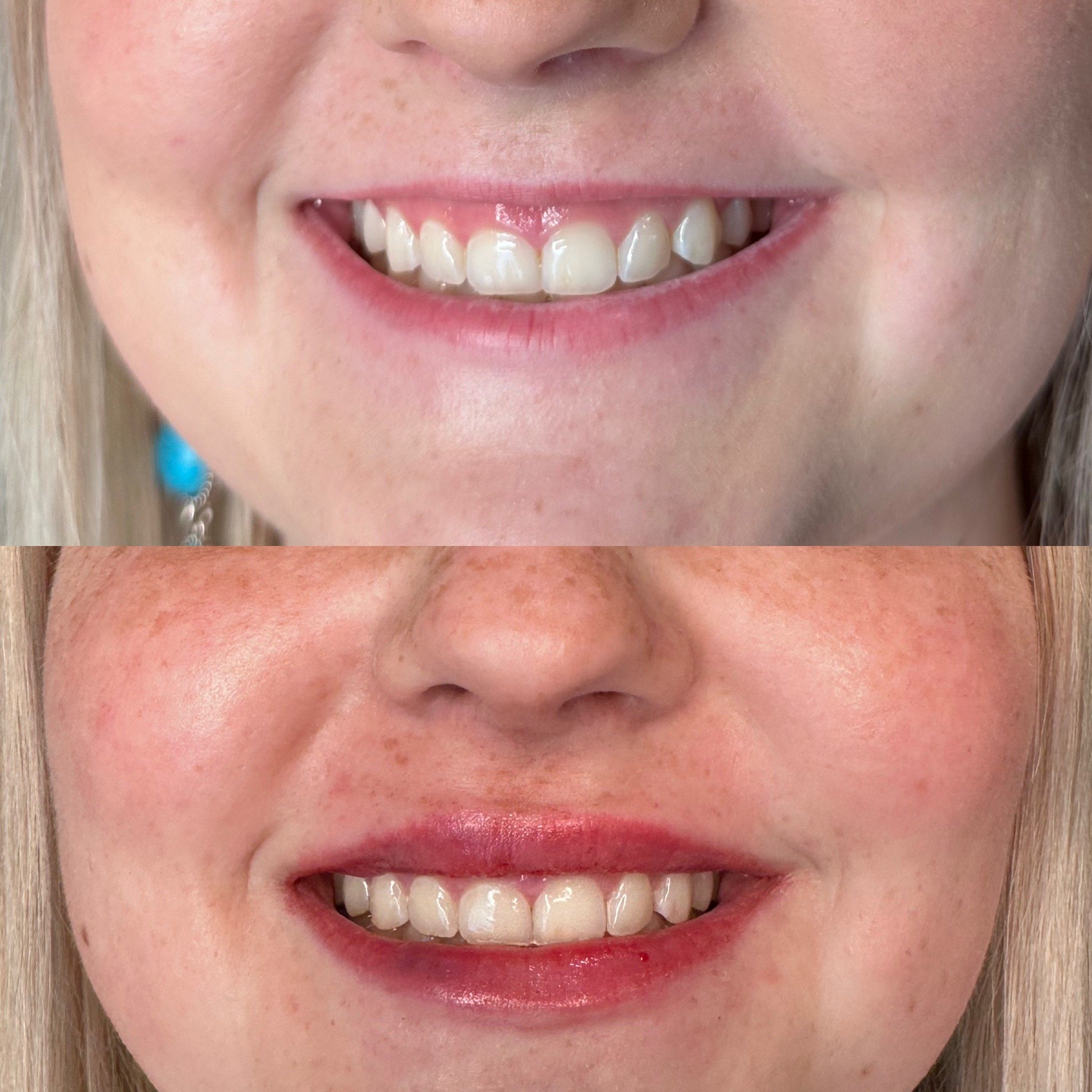 Lip flip and filler.JPG