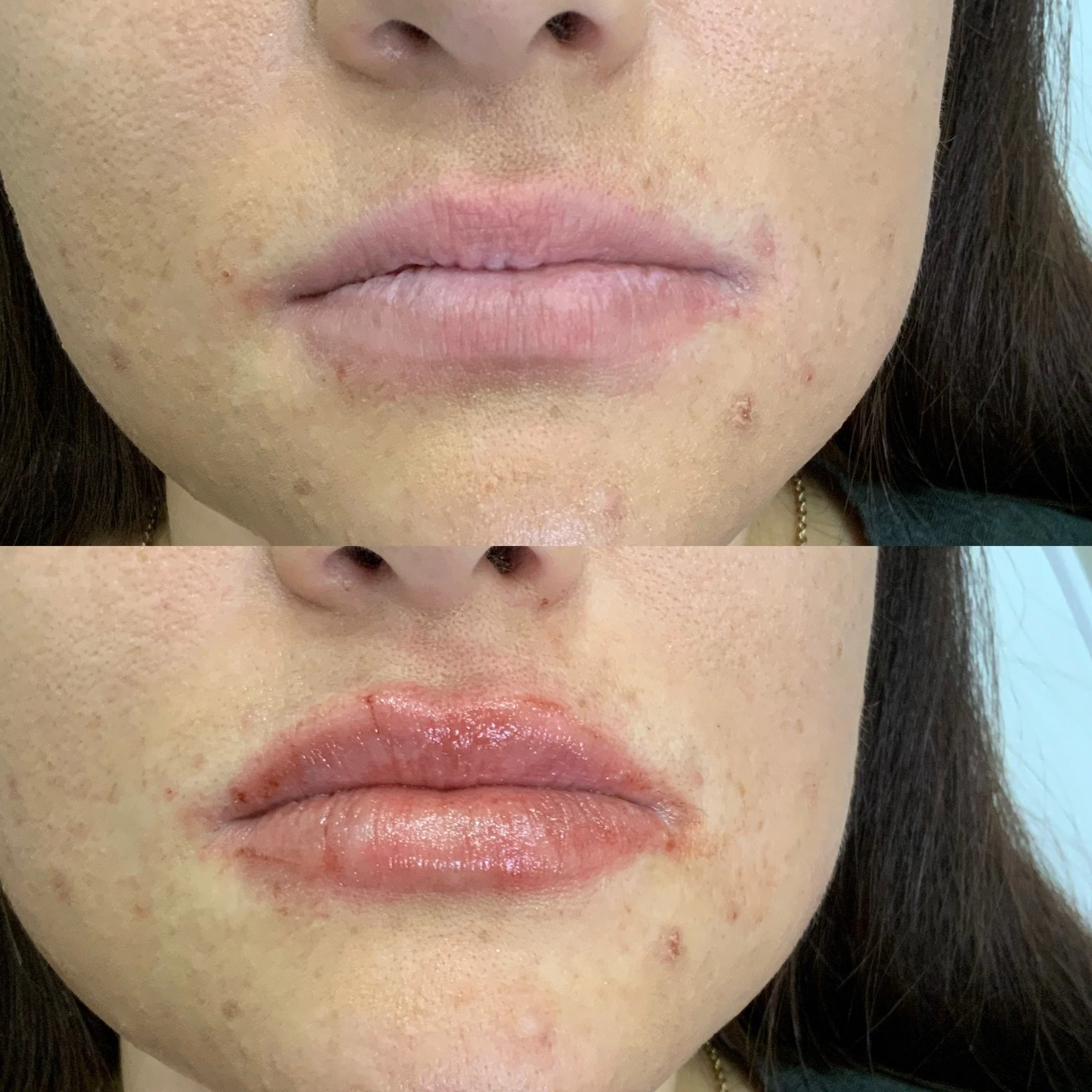 Lip FIller